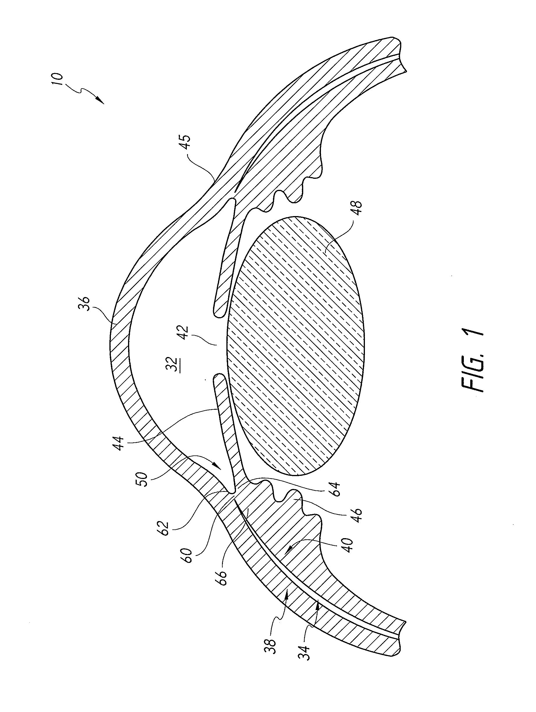 Systems and methods for delivering an ocular implant to the suprachoroidal space within an eye