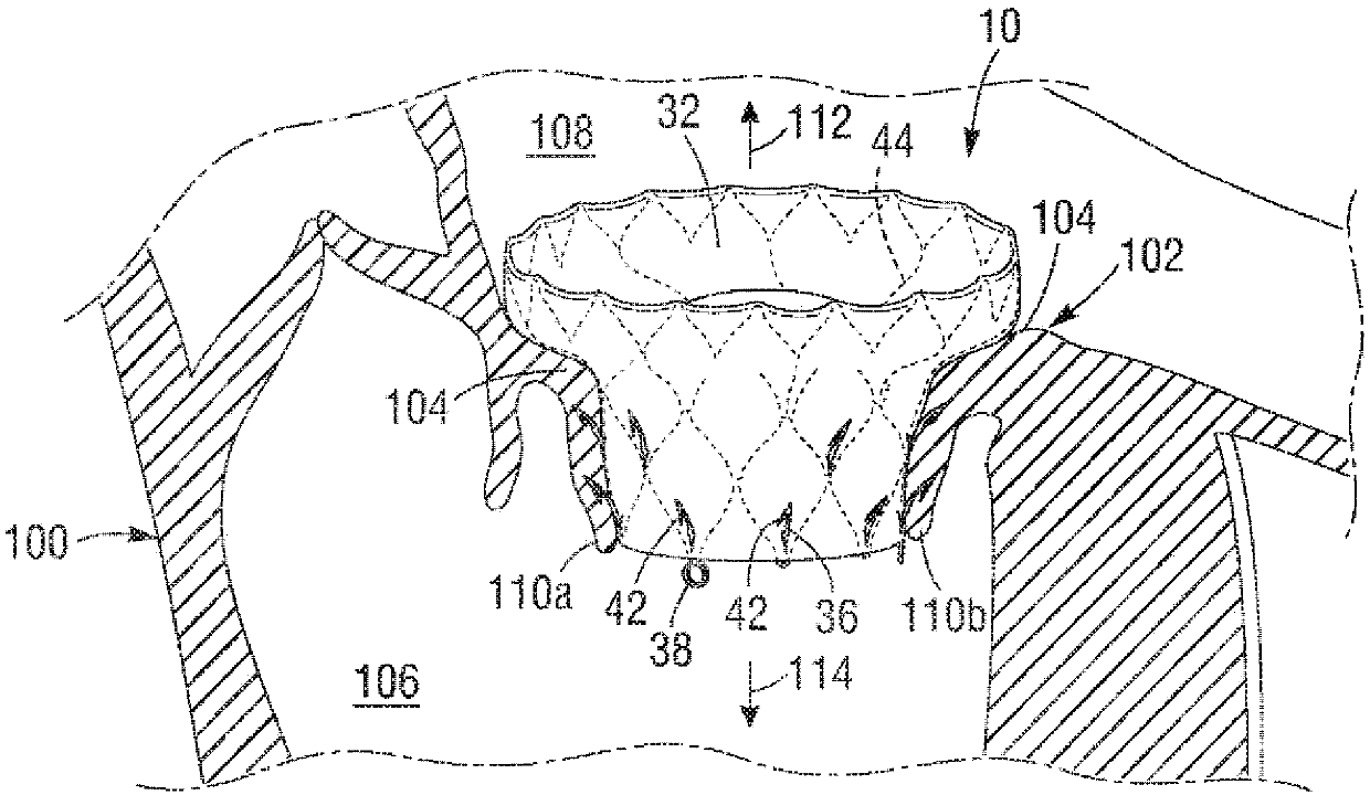 Percutaneous mitral valve replacement device