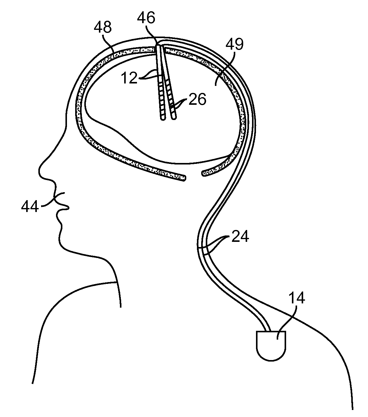 Neurostimulation system for selectively estimating volume of activation and providing therapy