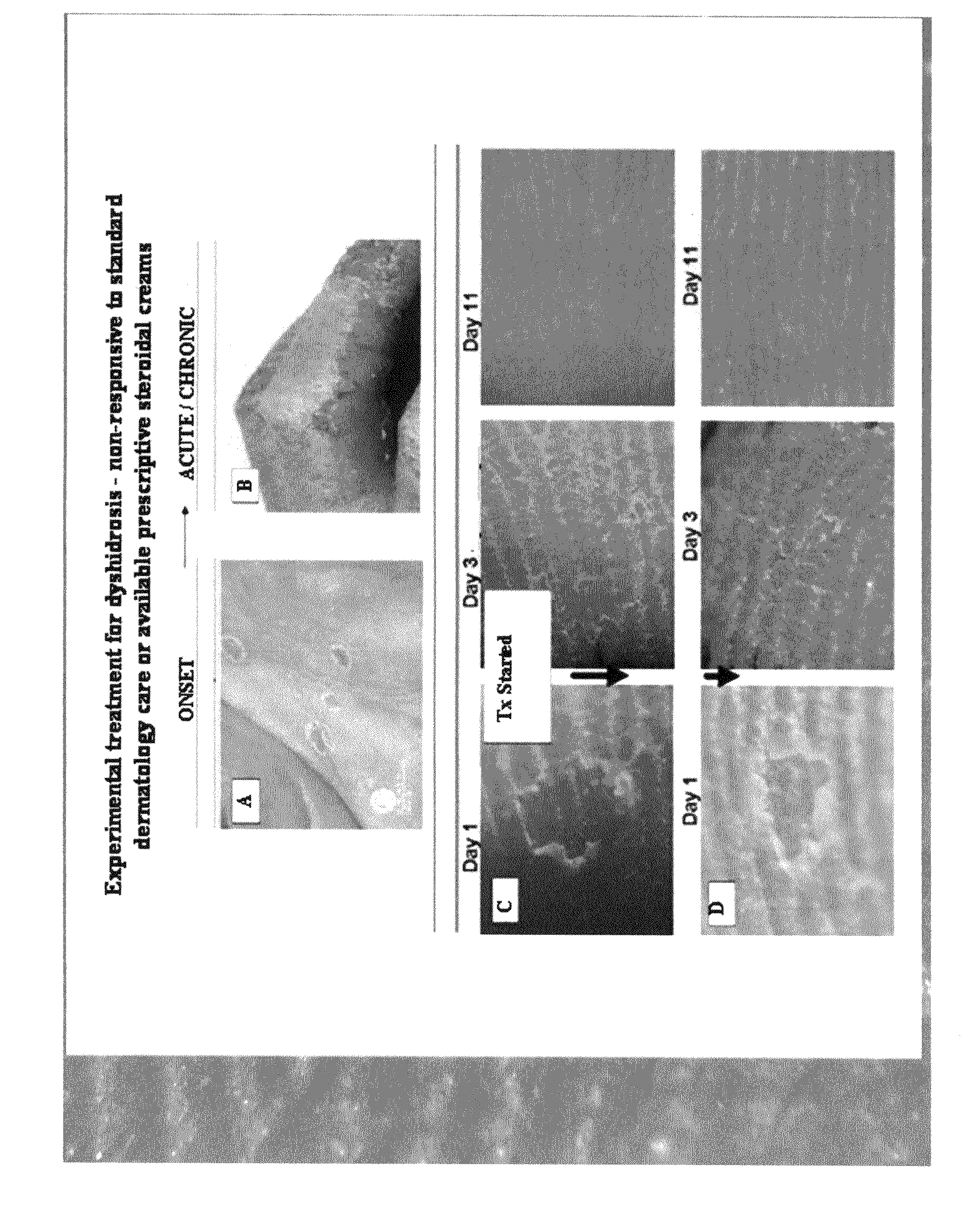Method of treating dyshidrosis(pompholyx) and related dry skin disorders