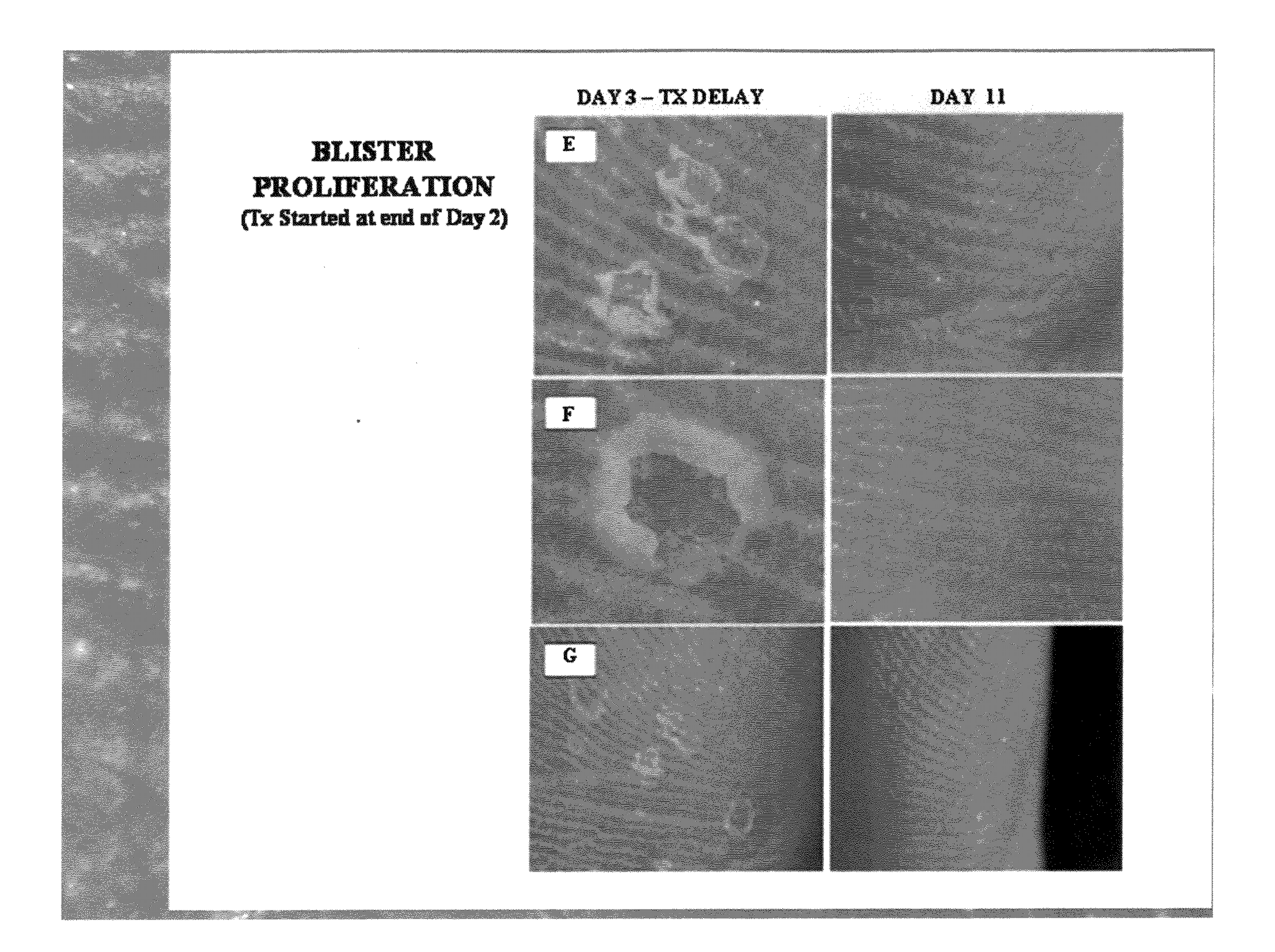 Method of treating dyshidrosis(pompholyx) and related dry skin disorders