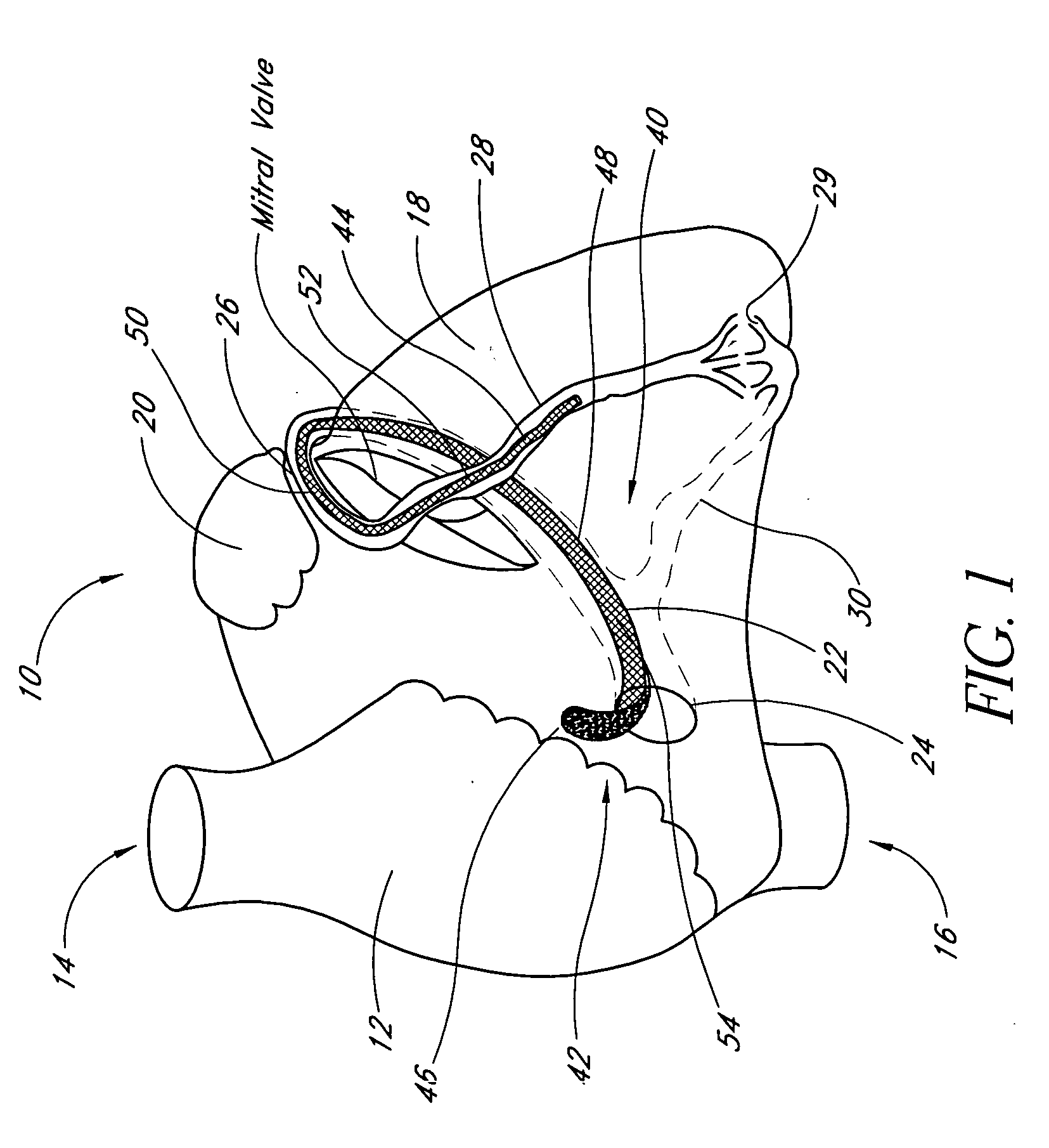 Remotely activated mitral annuloplasty system and methods