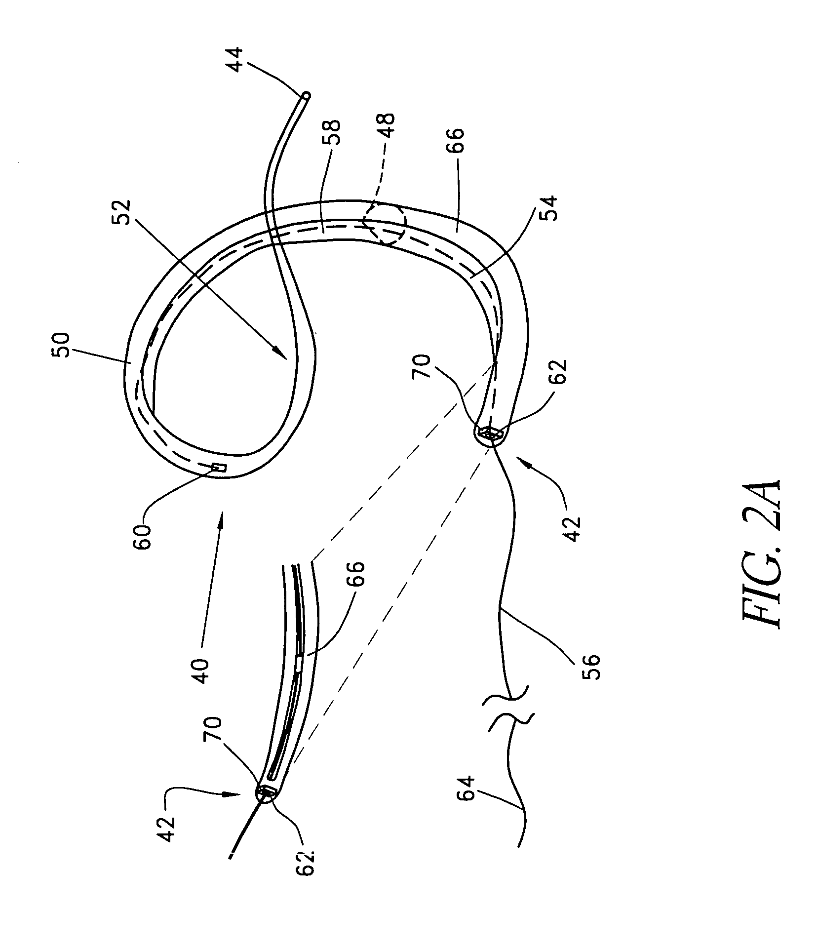 Remotely activated mitral annuloplasty system and methods