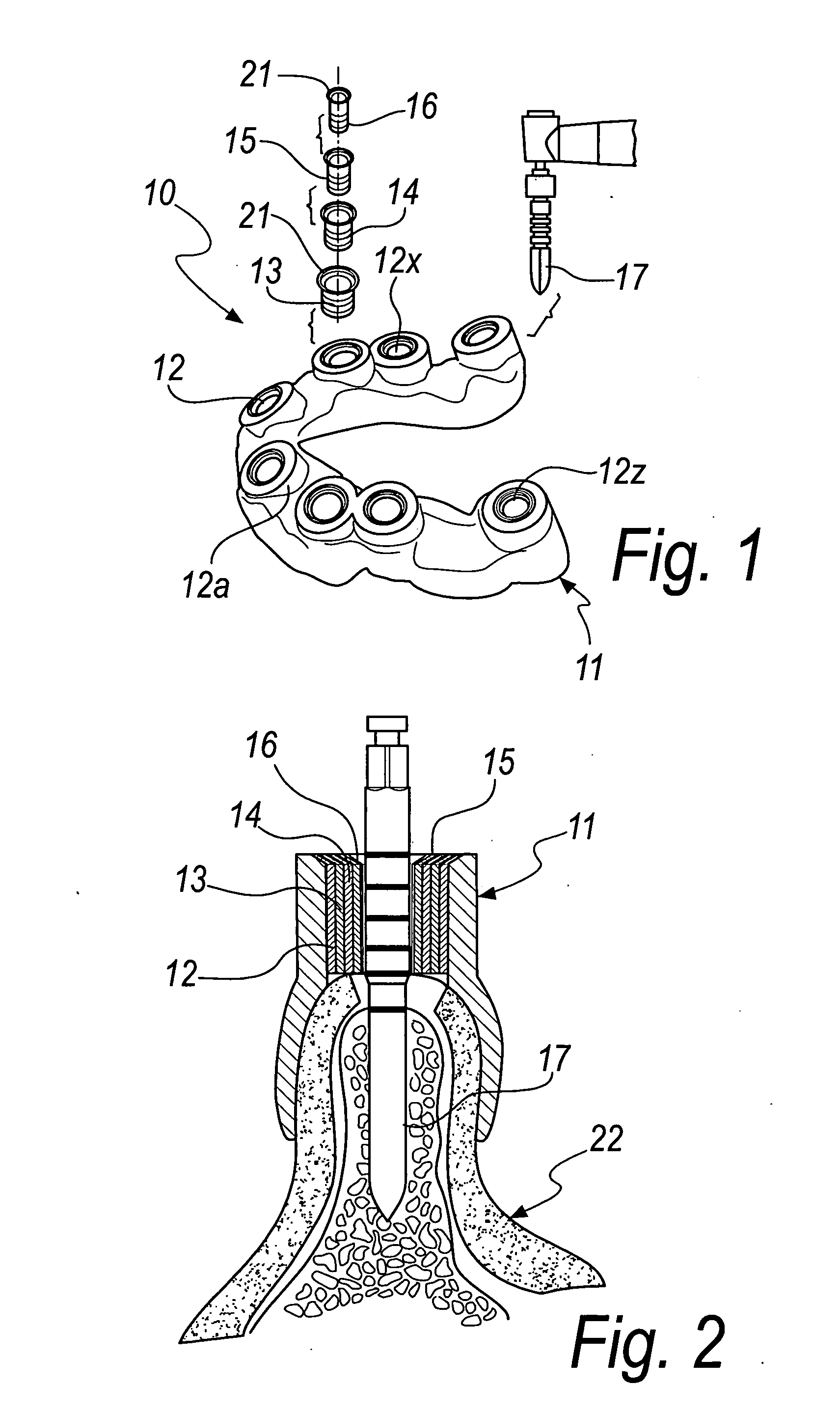 Apparatus for providing implantation sites to be provided in dental surgery, and a method to be performed with such apparatus