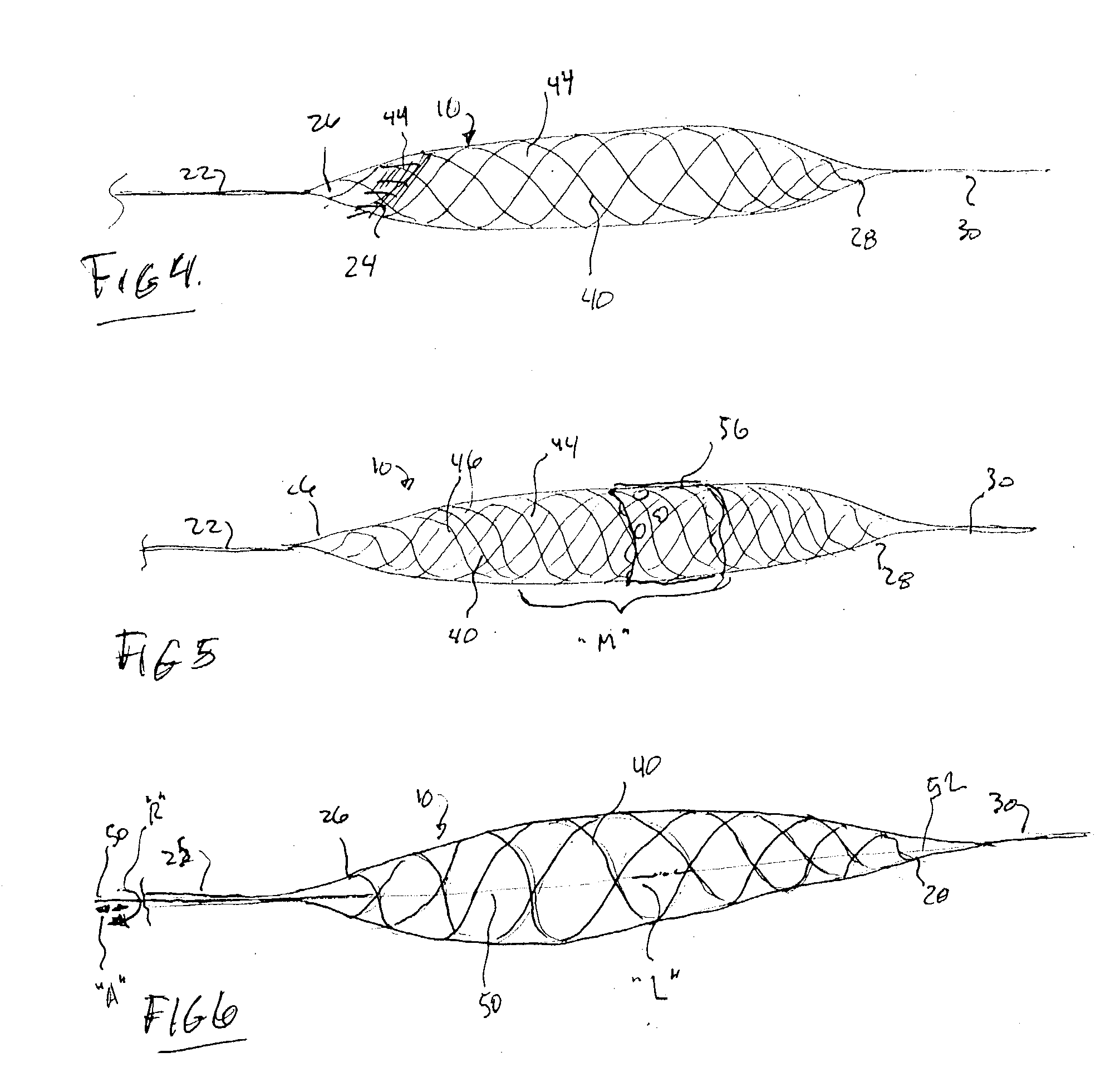 Aneurysm buttress arrangement
