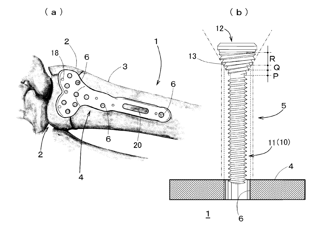 Locking Plate System for Treatment of Fracture of Distal Radius