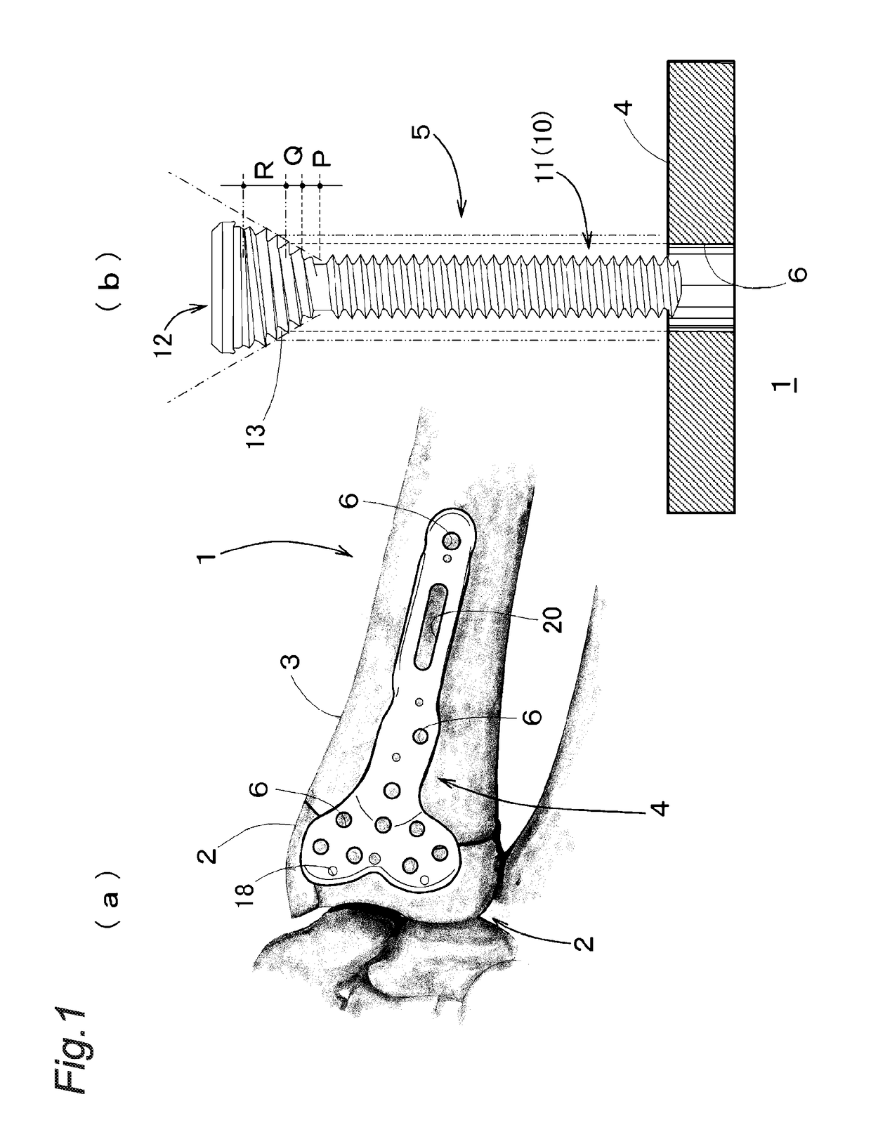 Locking Plate System for Treatment of Fracture of Distal Radius