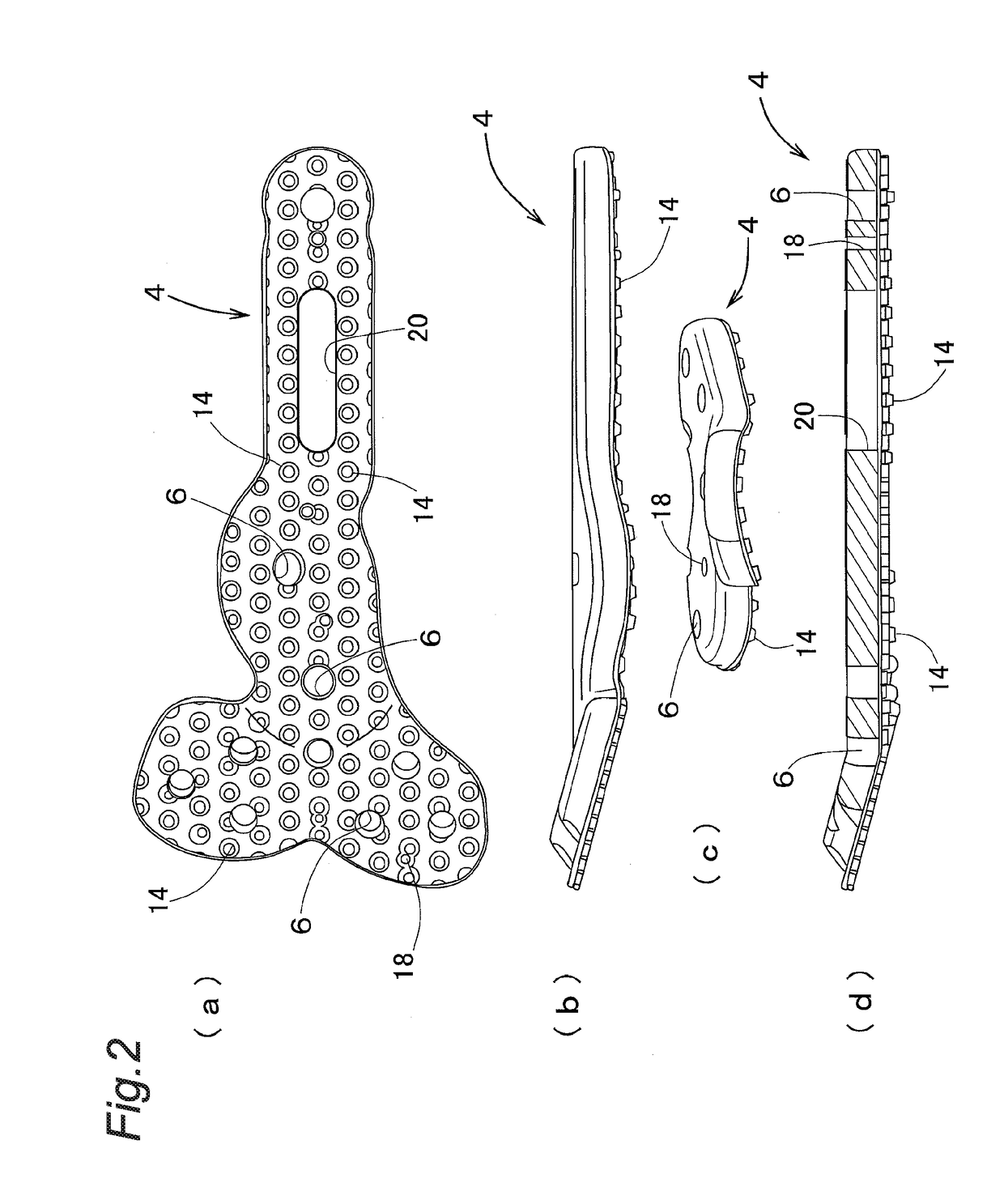 Locking Plate System for Treatment of Fracture of Distal Radius