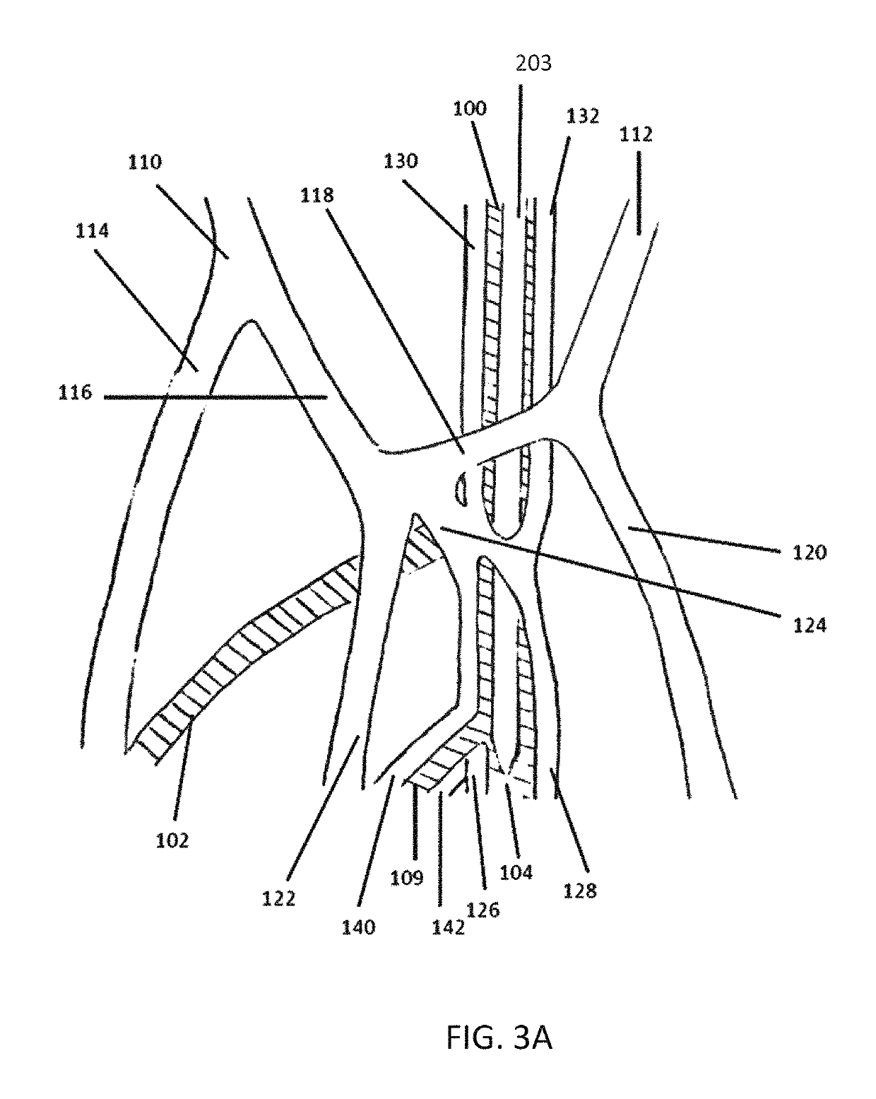 Methods for treating hypertension and reducing blood pressure with formation of fistula