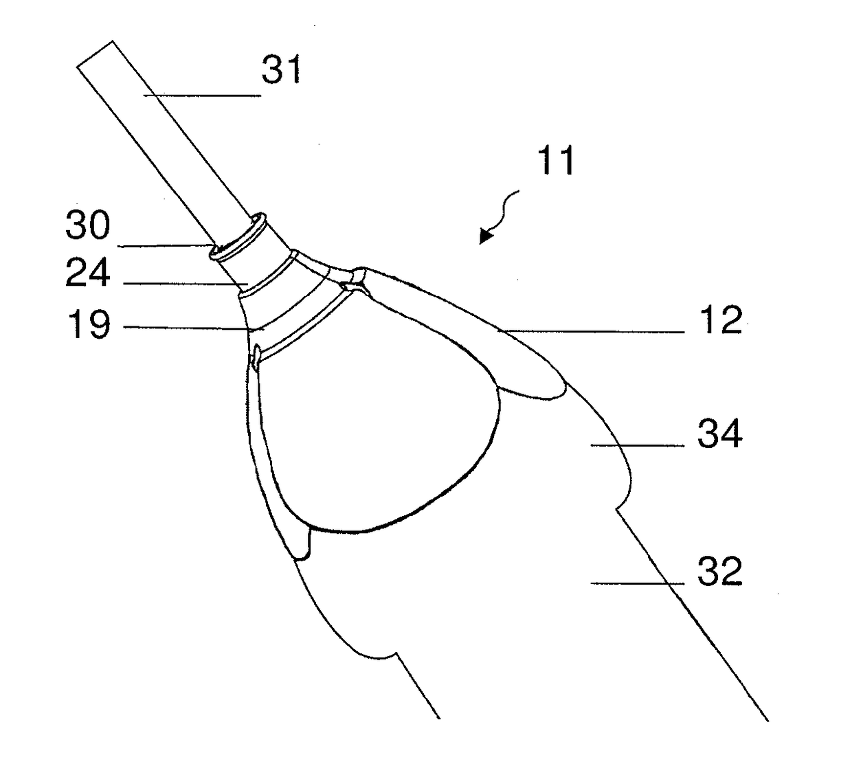 Device and method for external urinary incontinence treatment for men