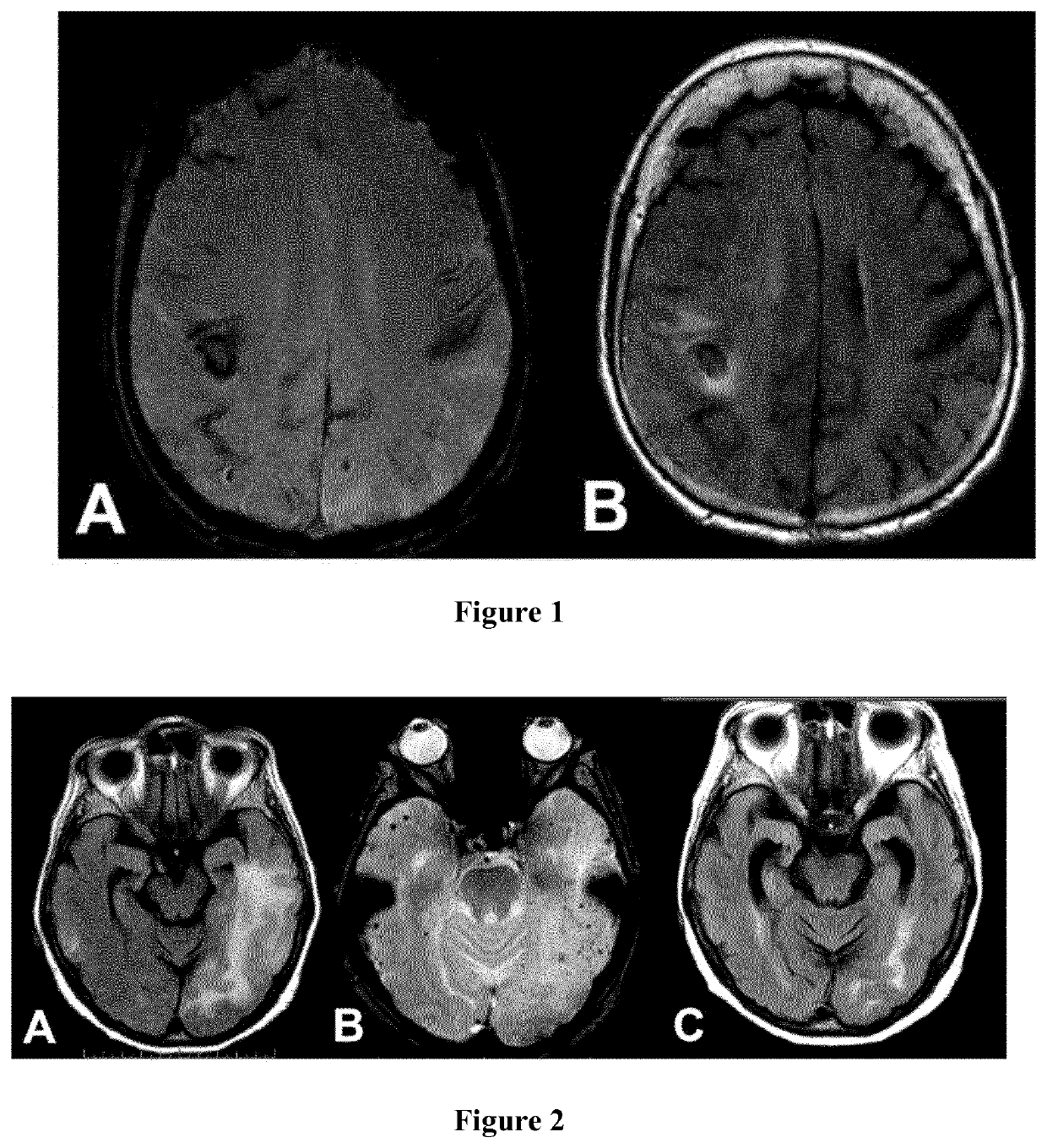 Methods for diagnosing a cerebral amyloid angiopathy
