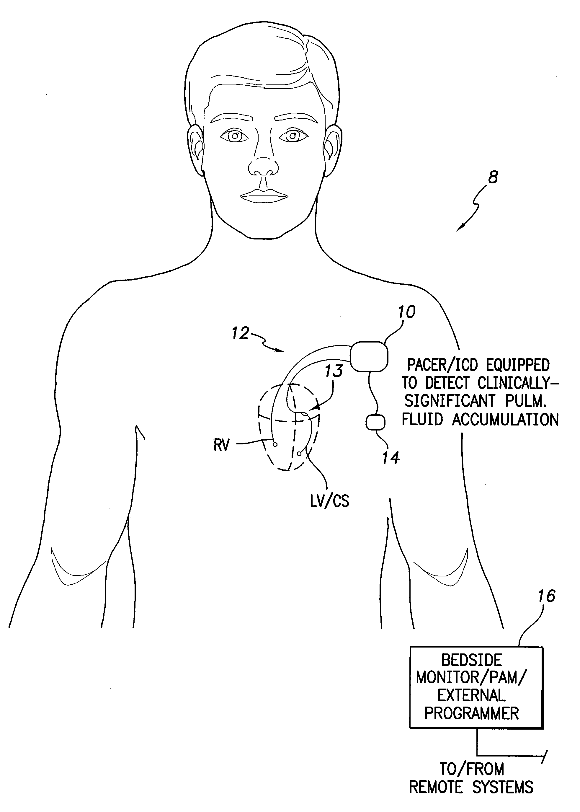 System and Method for Detecting a Clinically-Significant Pulmonary Fluid Accumulation Using an Implantable Medical Device