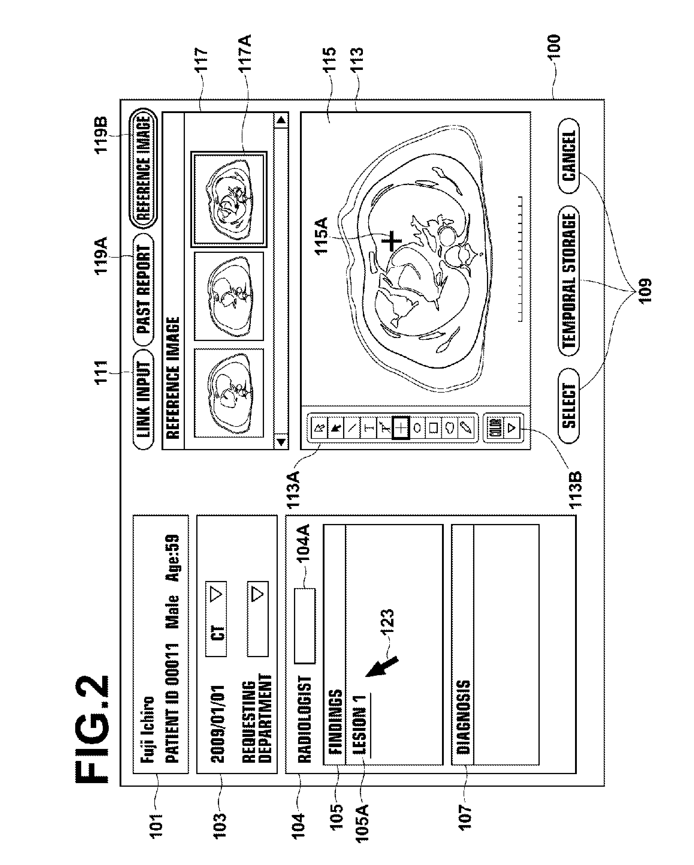 Lesion area extraction apparatus, method, and program