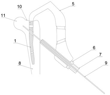 Implanting device for femoral intertrochanteric fracture conformal nail