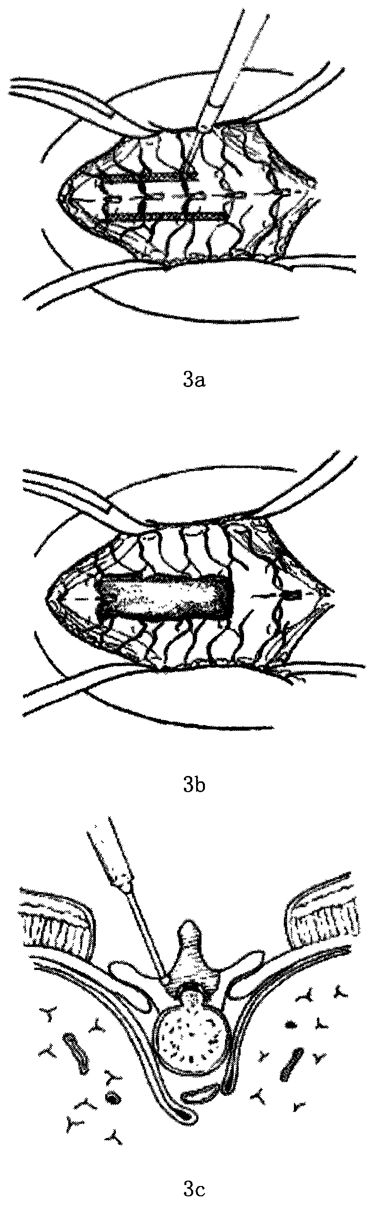 Trans-zygapophyseal and costotransverse joint approach circumspinal decompression method and bone knife for surgery