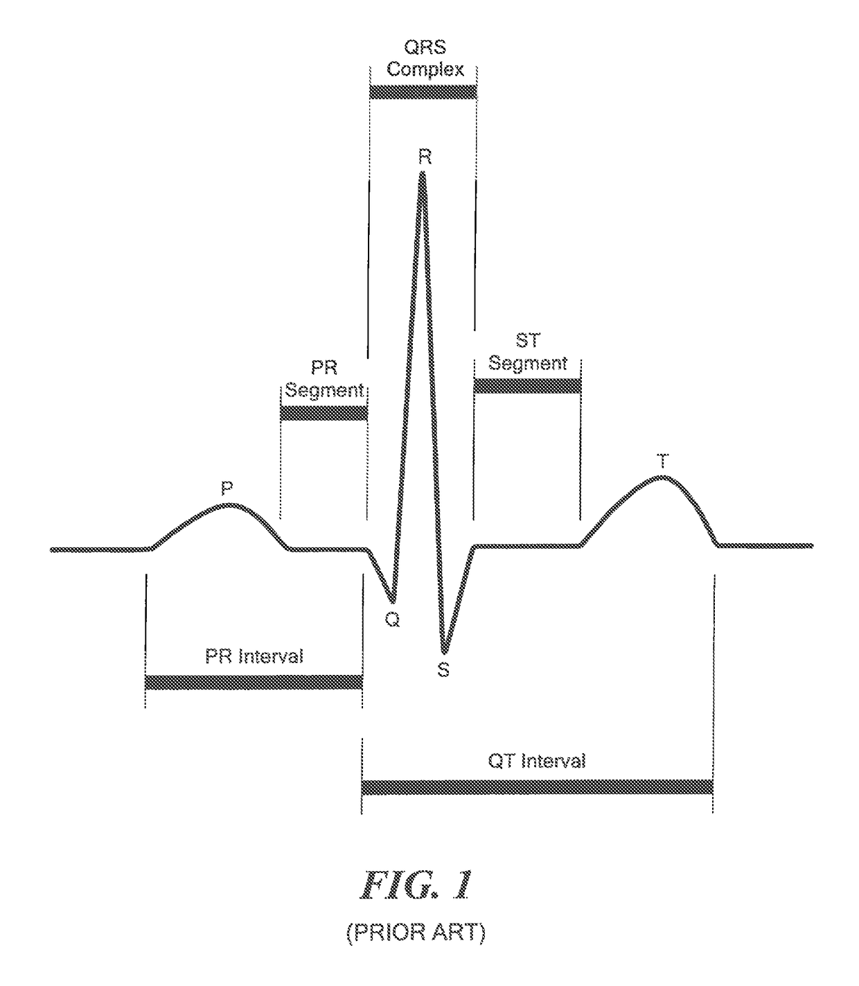 Systems and methods for detecting a physiological abnormality in a patient by using cardiac or other chaos in combination with non-increasing parasympathetic modulation