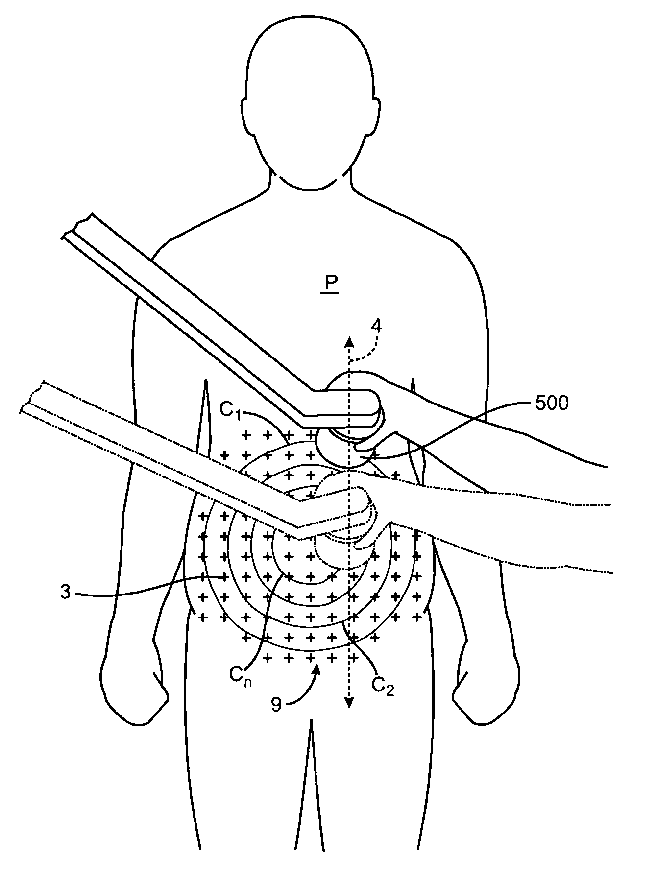 Apparatus and methods for the destruction of adipose tissue