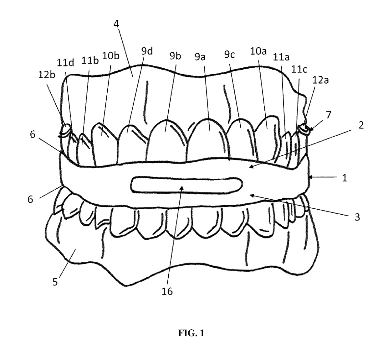 Intraoral functional device for relieving obstructive sleep apnea syndrom, snoring and/or other airway disorders