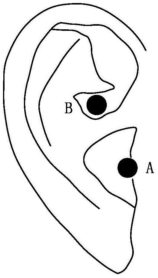 An ear vagus nerve stimulator