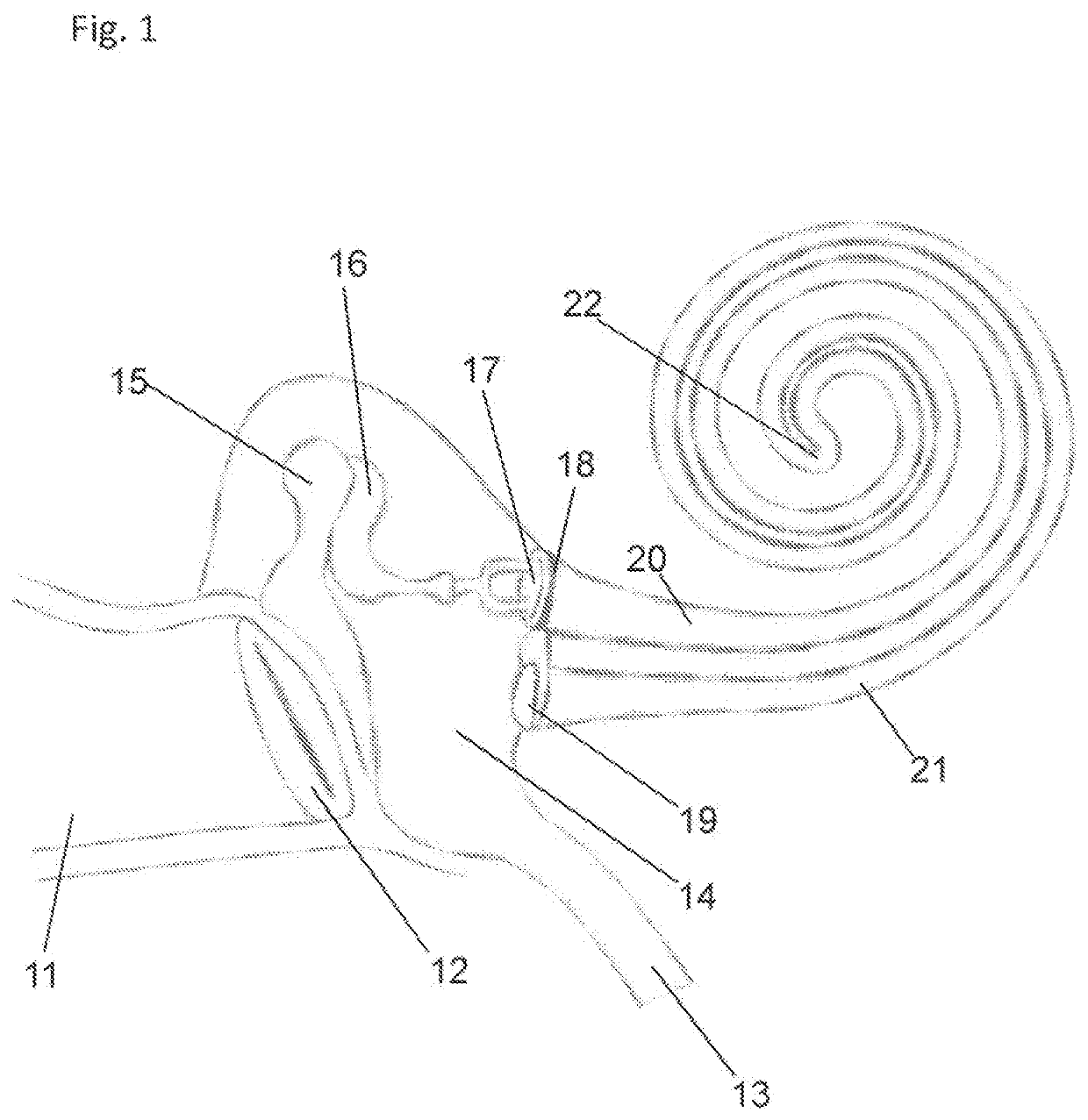 Method And Device For Substance Delivery To The Inner Ear