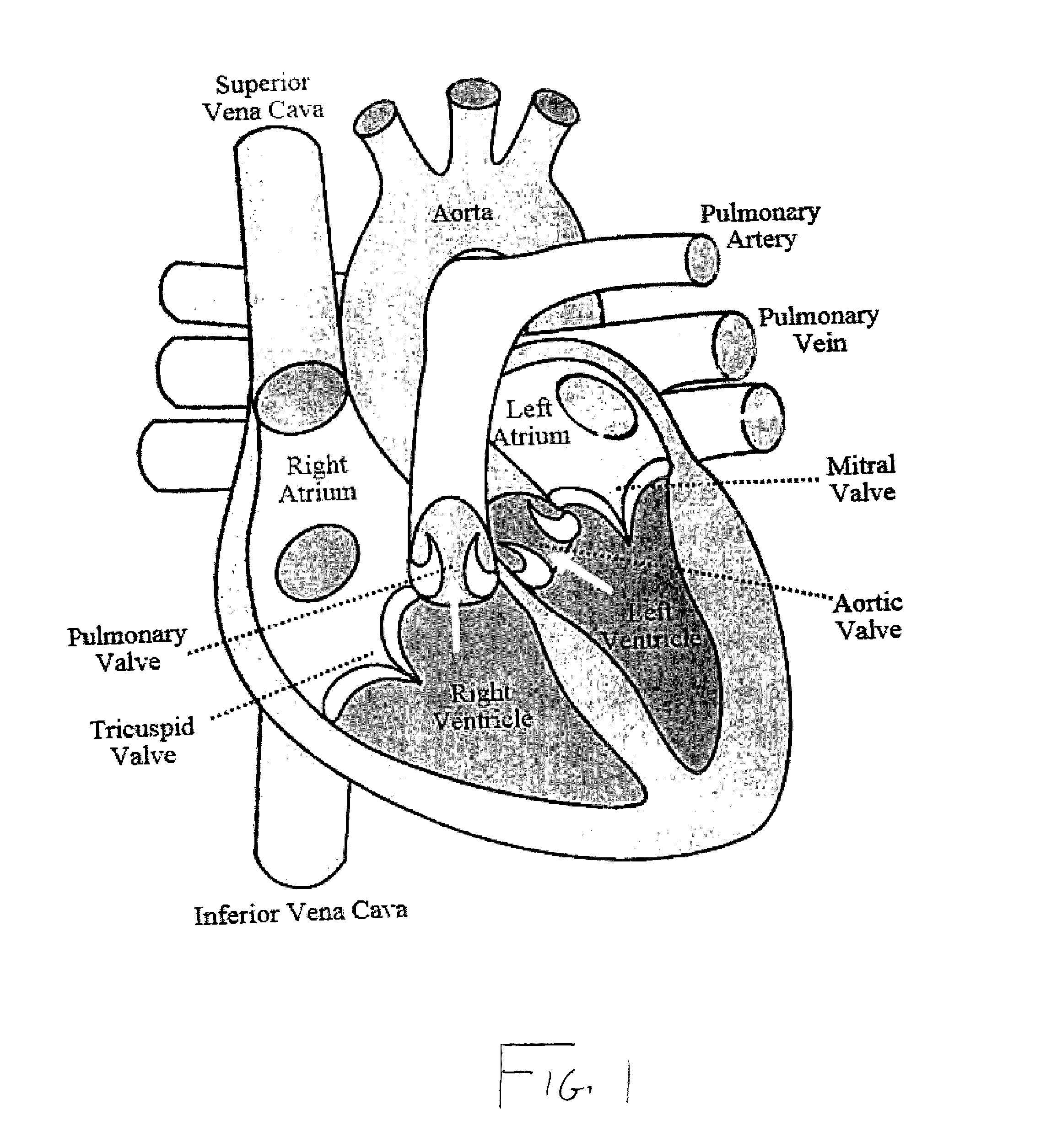 System for treating heart valve malfunction including mitral regurgitation