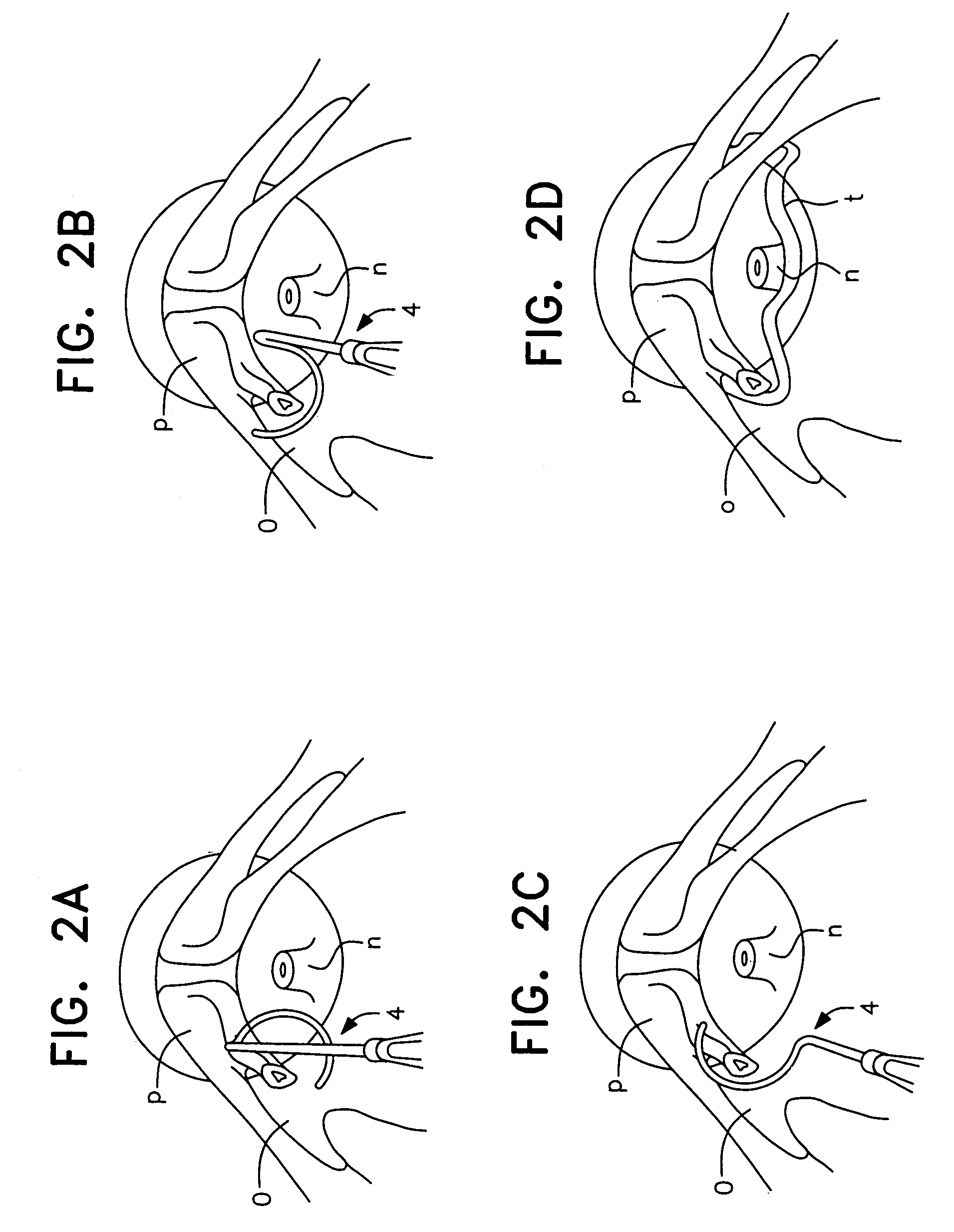 Surgical procedure for the treatment of female urinary incontinence: tension-free inside-out transobturator urethral suspension