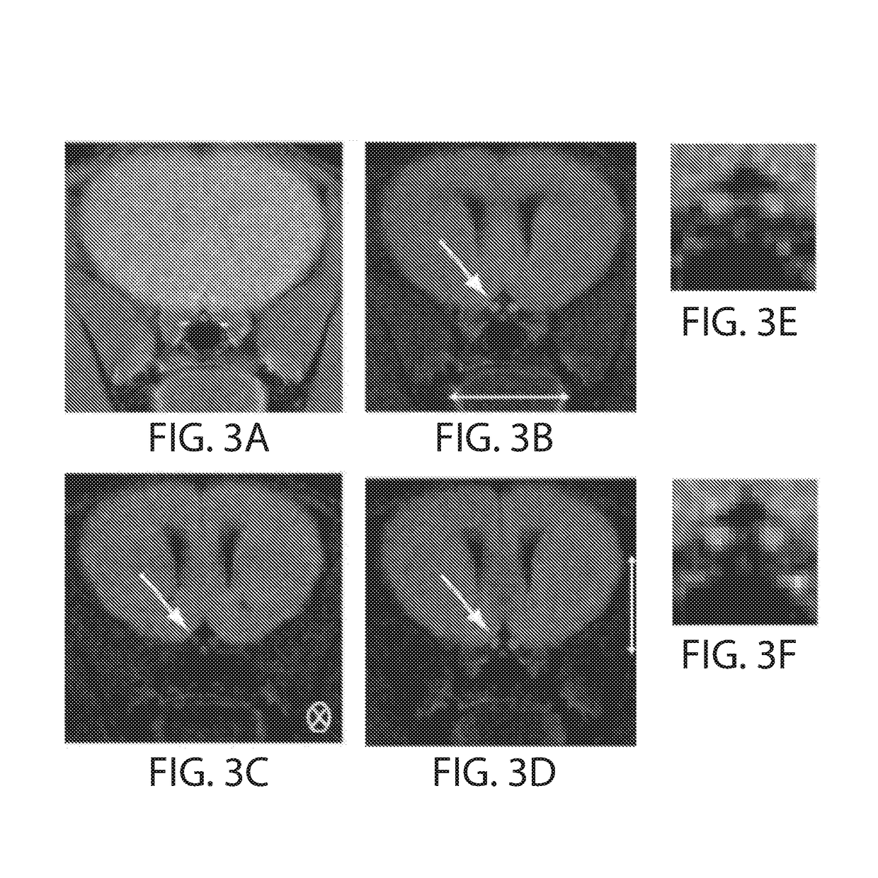 Lingo-1 antagonists and uses for treatment of demyelinating disorders