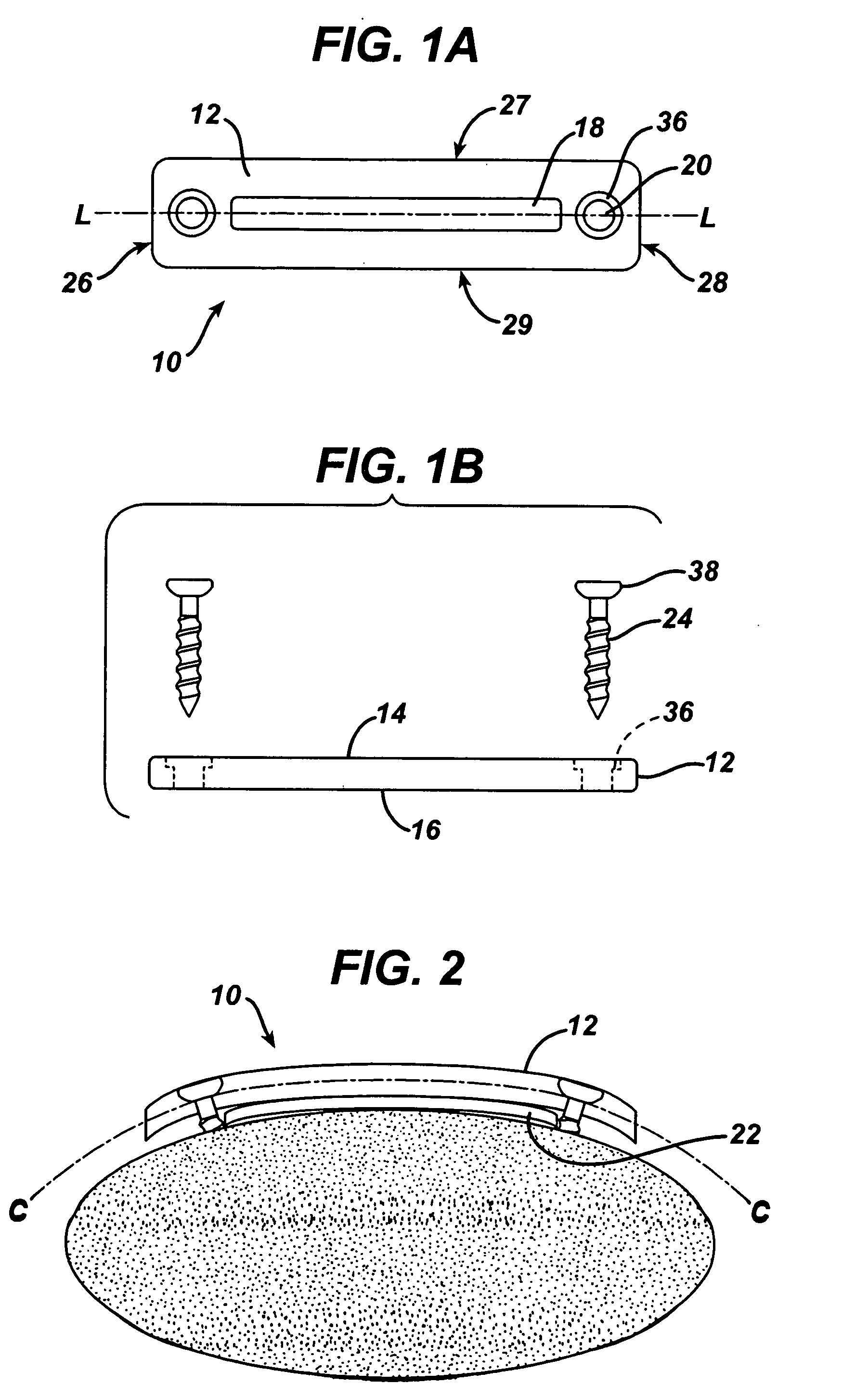 Implant fixation methods and apparatus