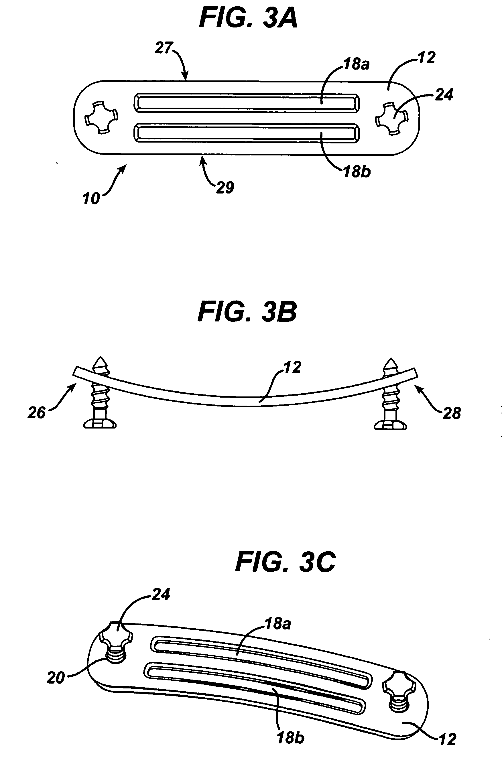 Implant fixation methods and apparatus