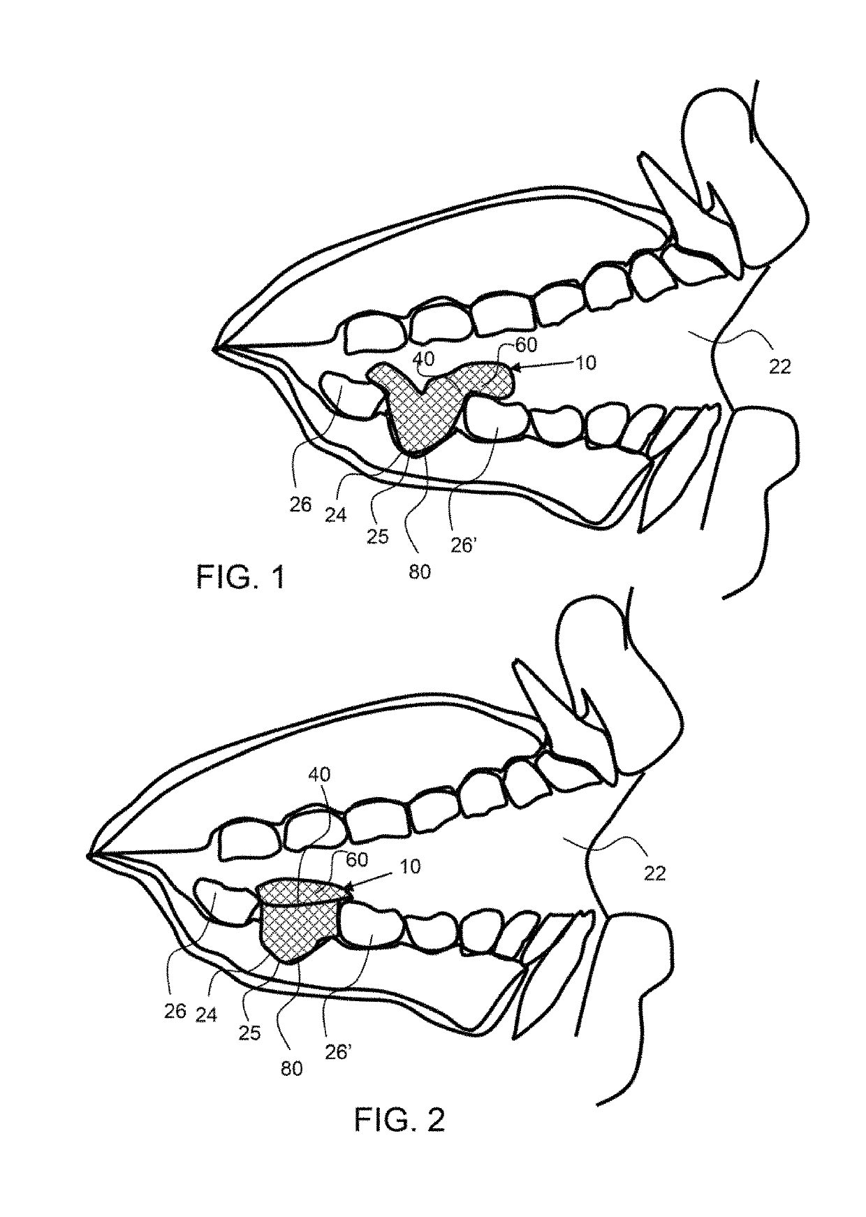 Method of oral hemostasis using a conformable non-disruptive hemostasis material