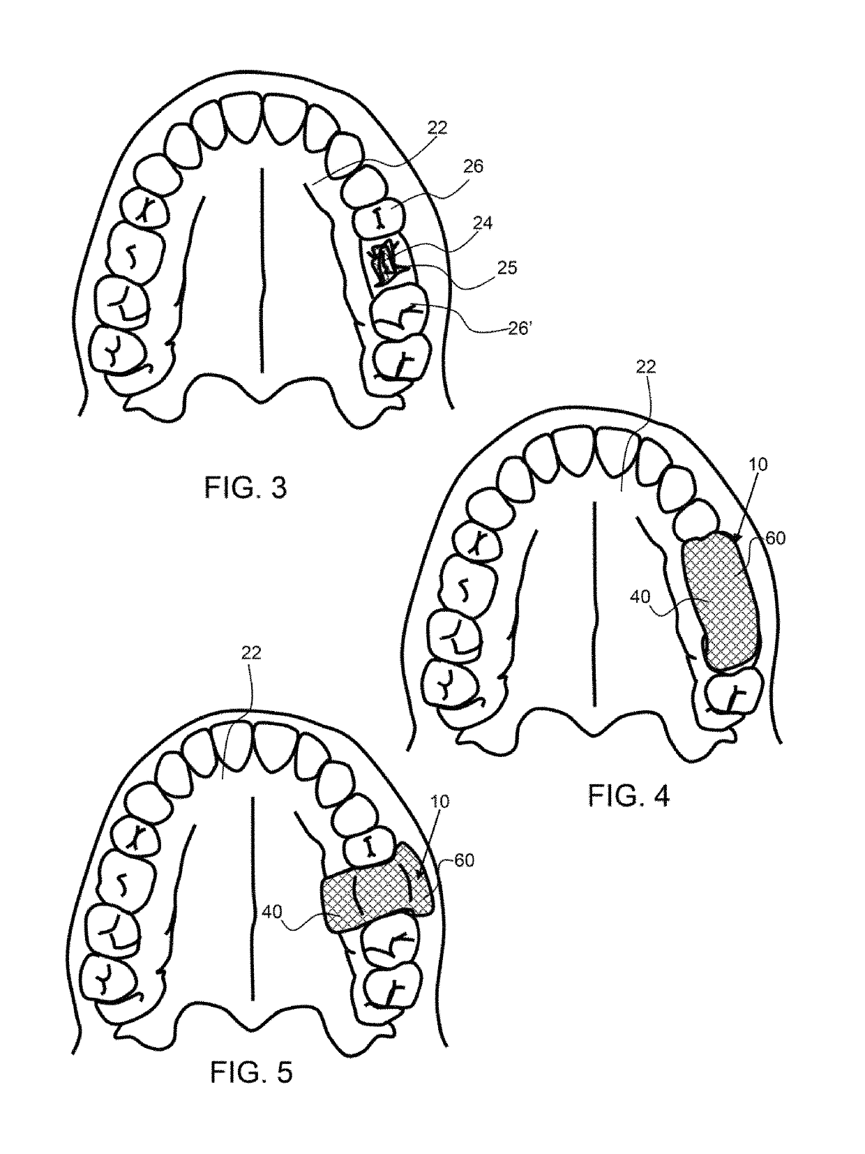 Method of oral hemostasis using a conformable non-disruptive hemostasis material