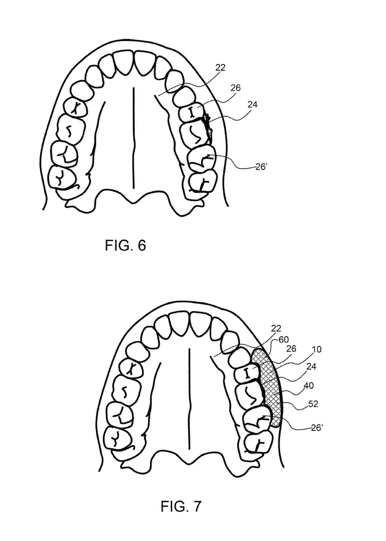 Method of oral hemostasis using a conformable non-disruptive hemostasis material