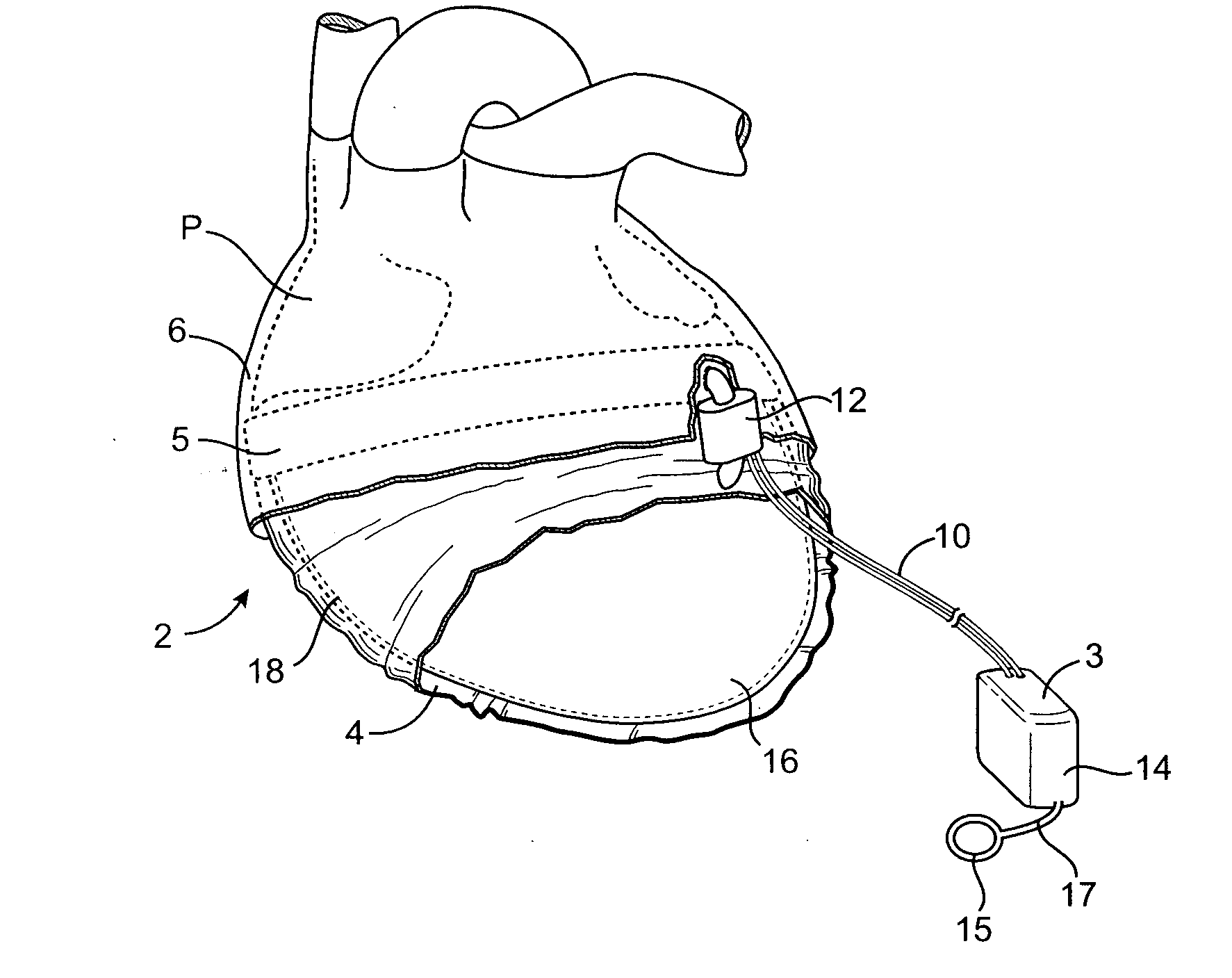 Devices and methods for providing cardiac assistance