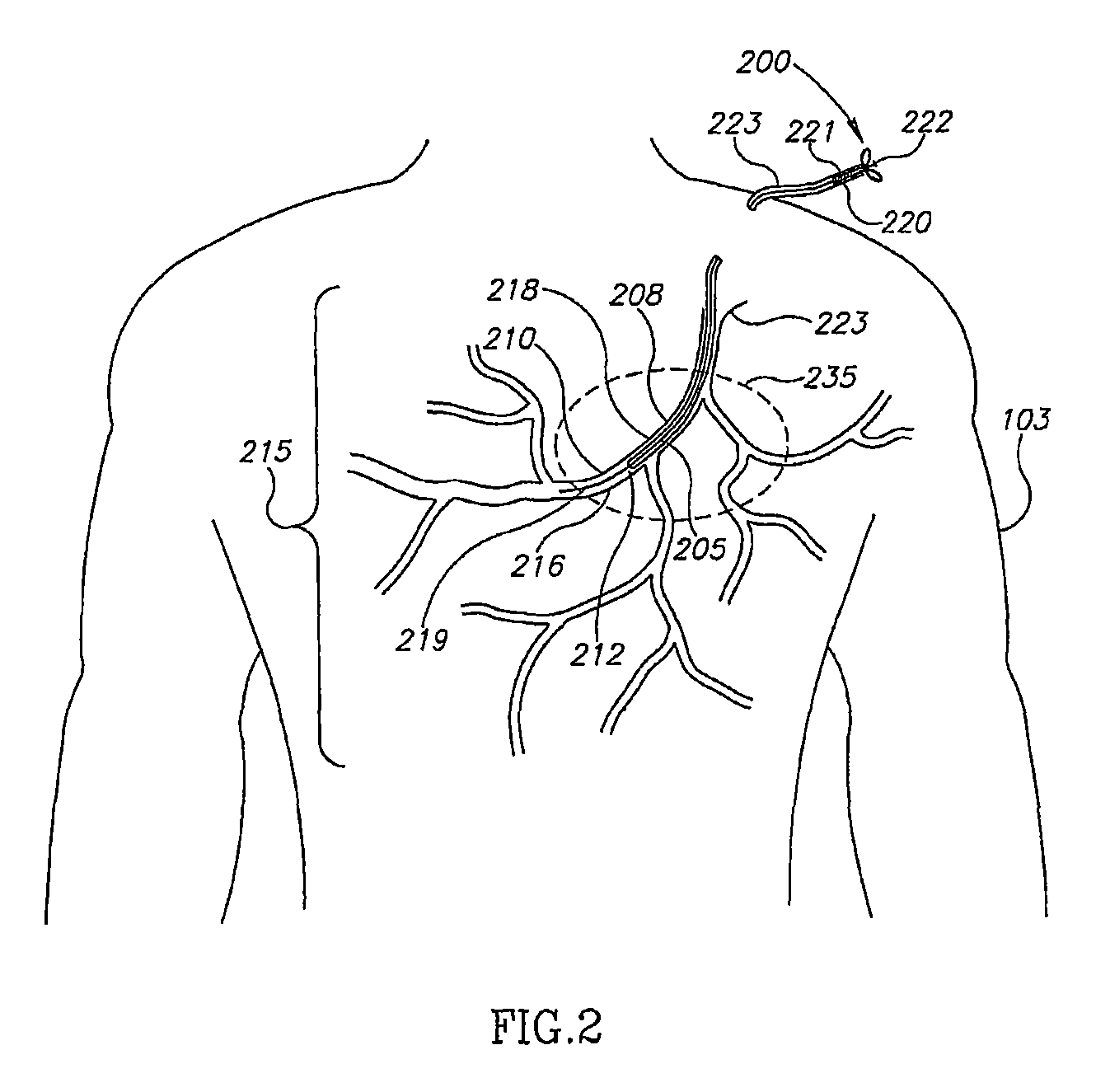 Method and apparatus for positioning a device in a tubular organ