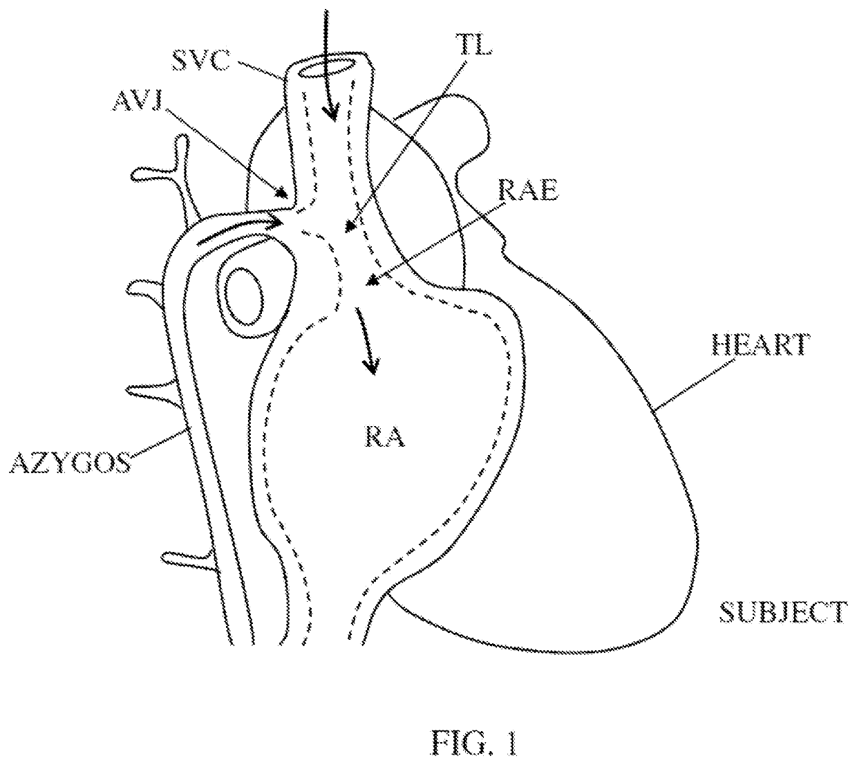 Controlling rate of blood flow to right atrium