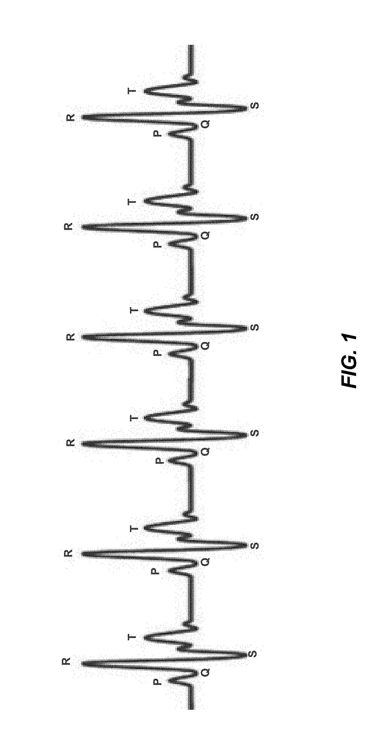 Method for the detecting electrocardiogram anomalies and corresponding system