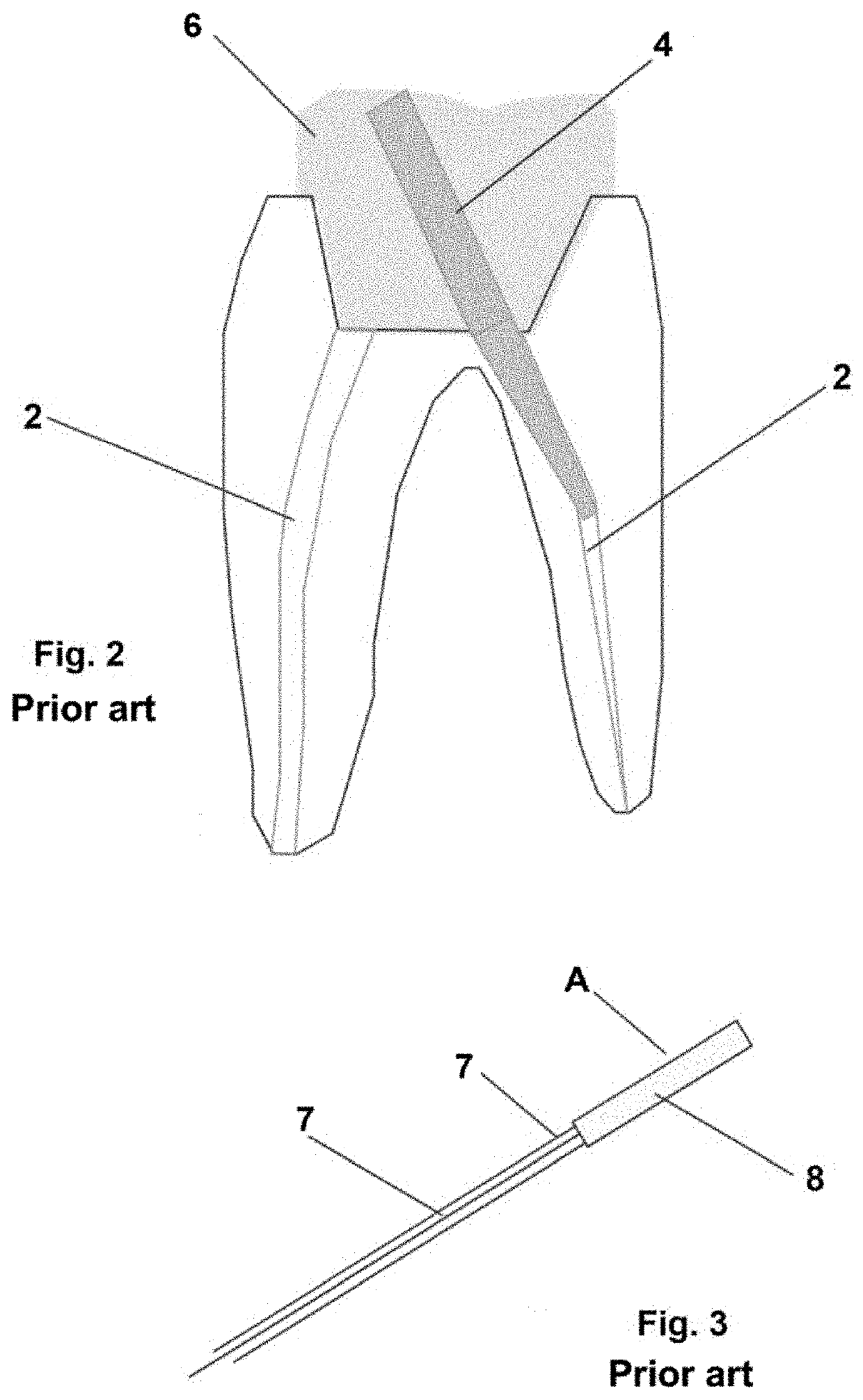 Crown and root dental restoration, method for performing one such restoration and method for etching one such dental restoration