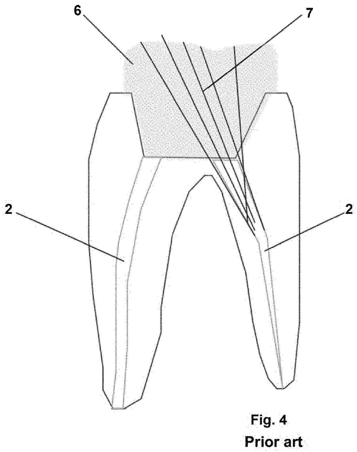 Crown and root dental restoration, method for performing one such restoration and method for etching one such dental restoration