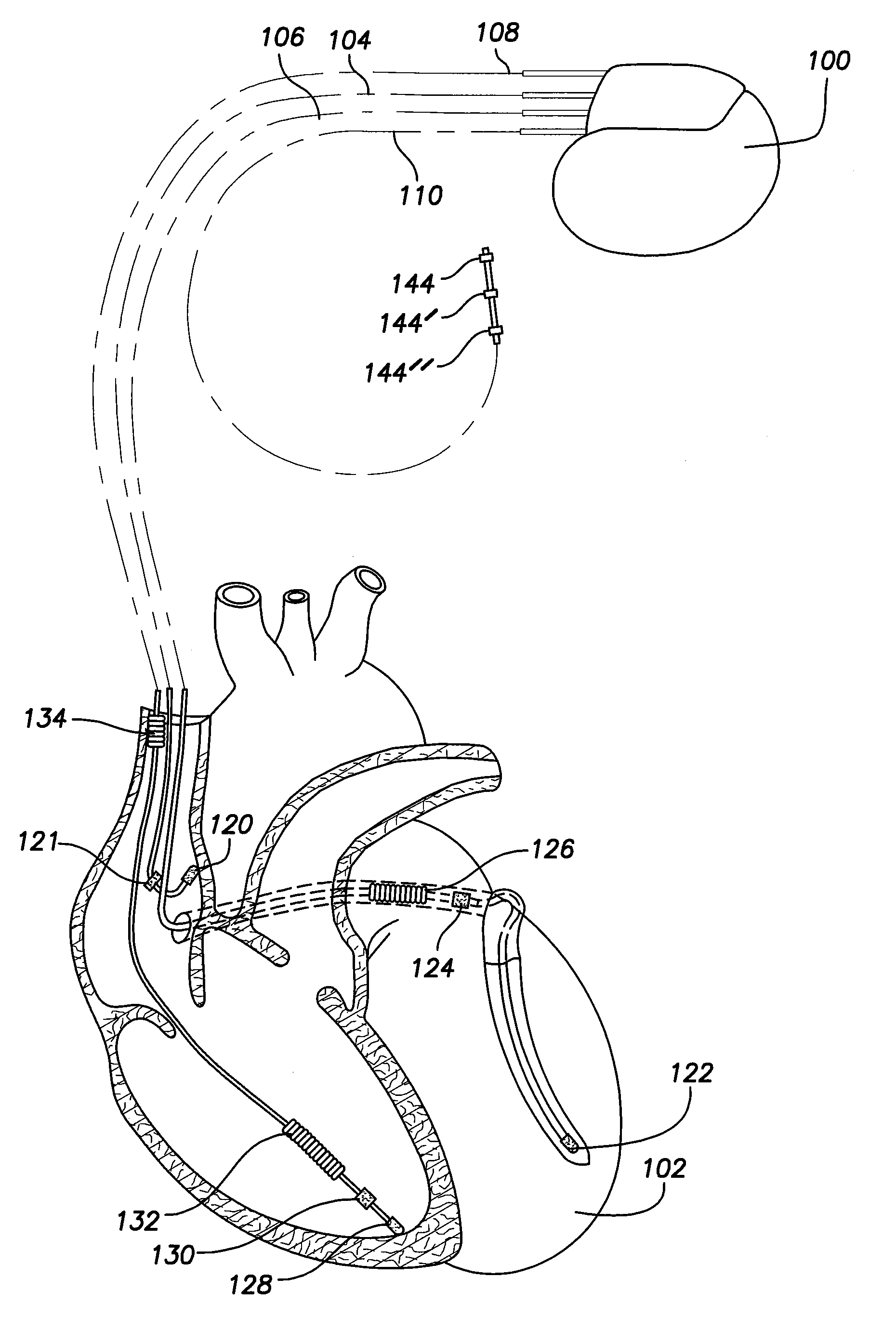 Systems and methods for controlling ventricular pacing in patients with long inter-atrial conduction delays