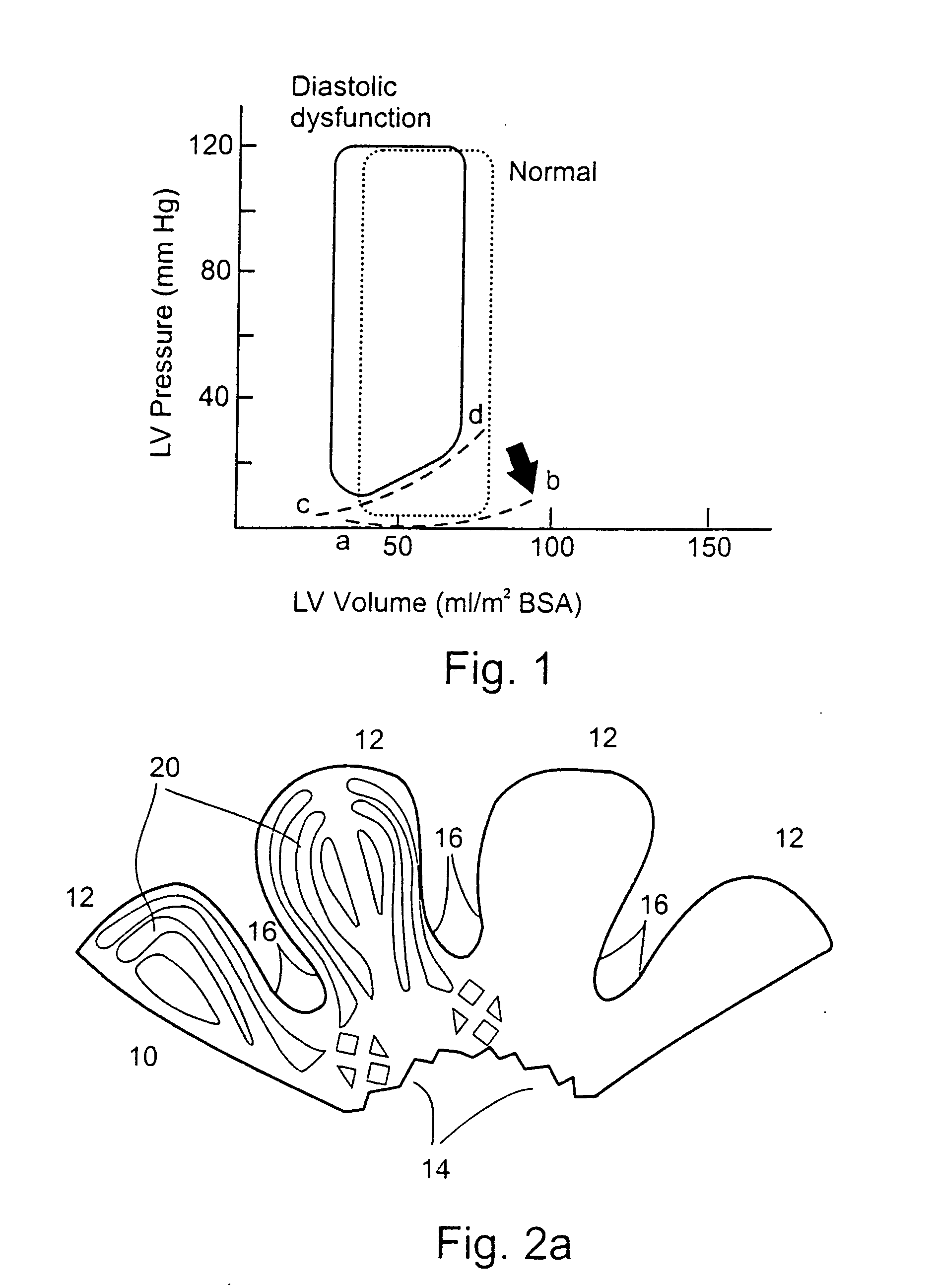 In-vivo method and device for improving diastolic function of the left ventricle