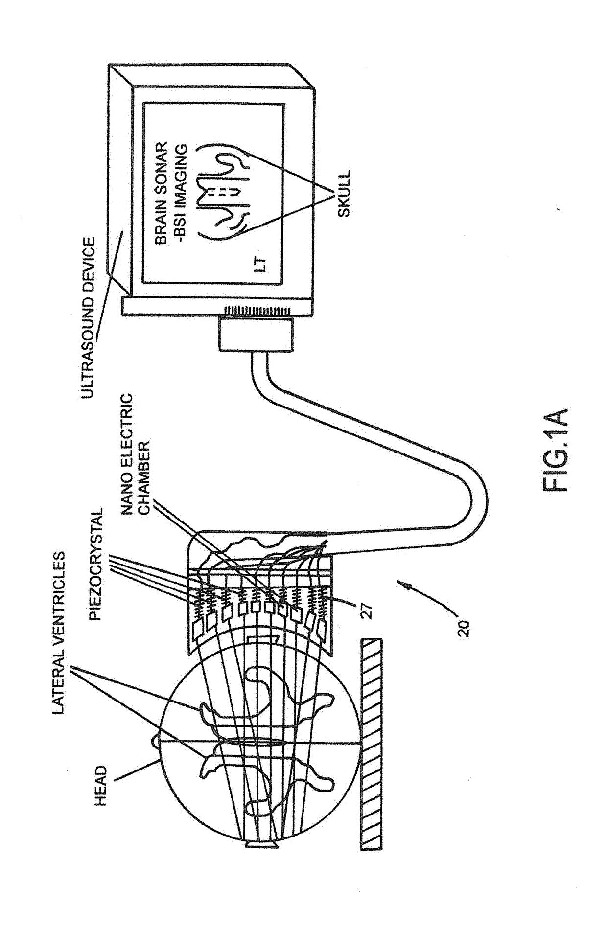 Non-invasive dynamic measurement of intracranial reserve space