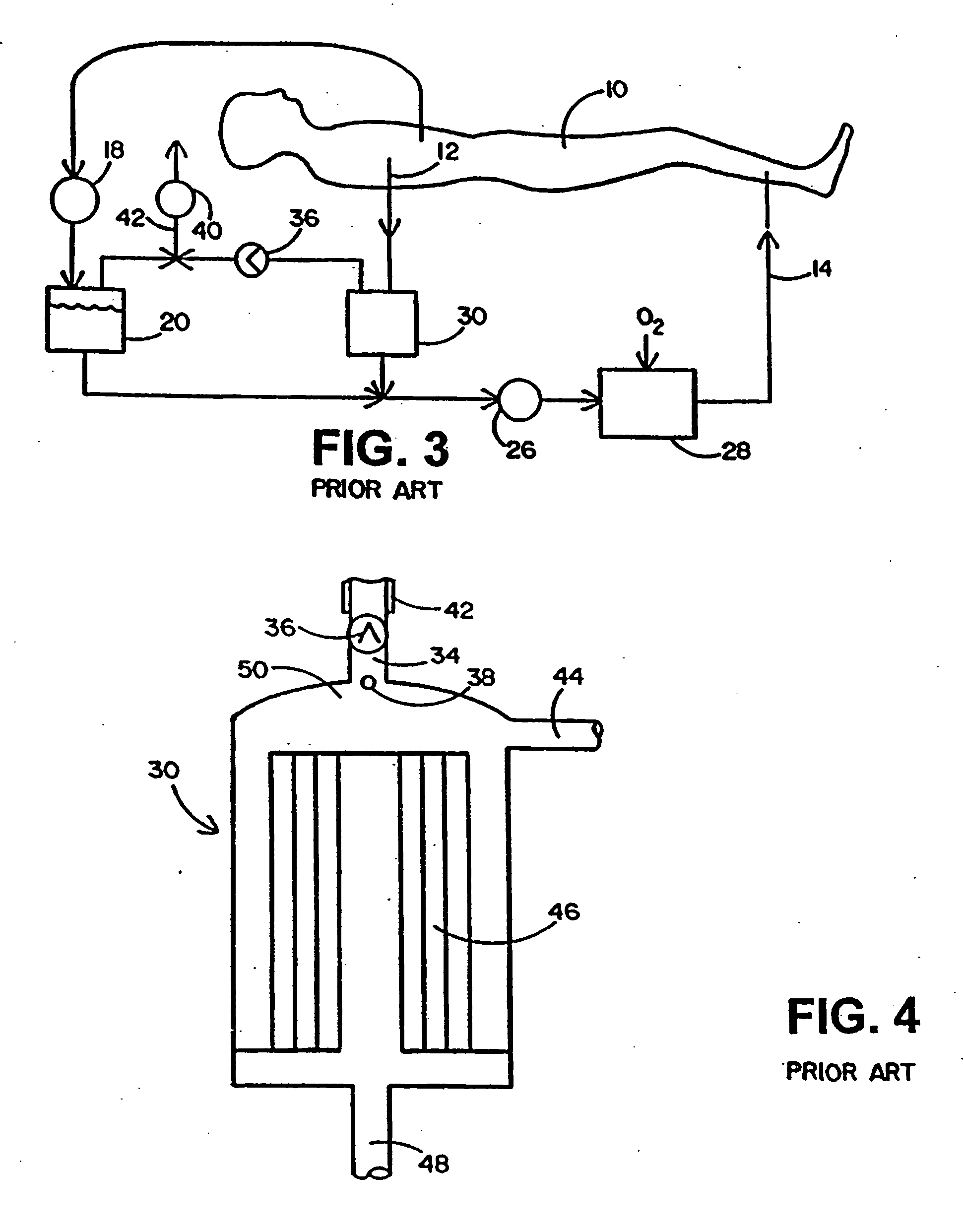 Cardiopulmonary bypass extracorporeal blood circuit apparatus and method