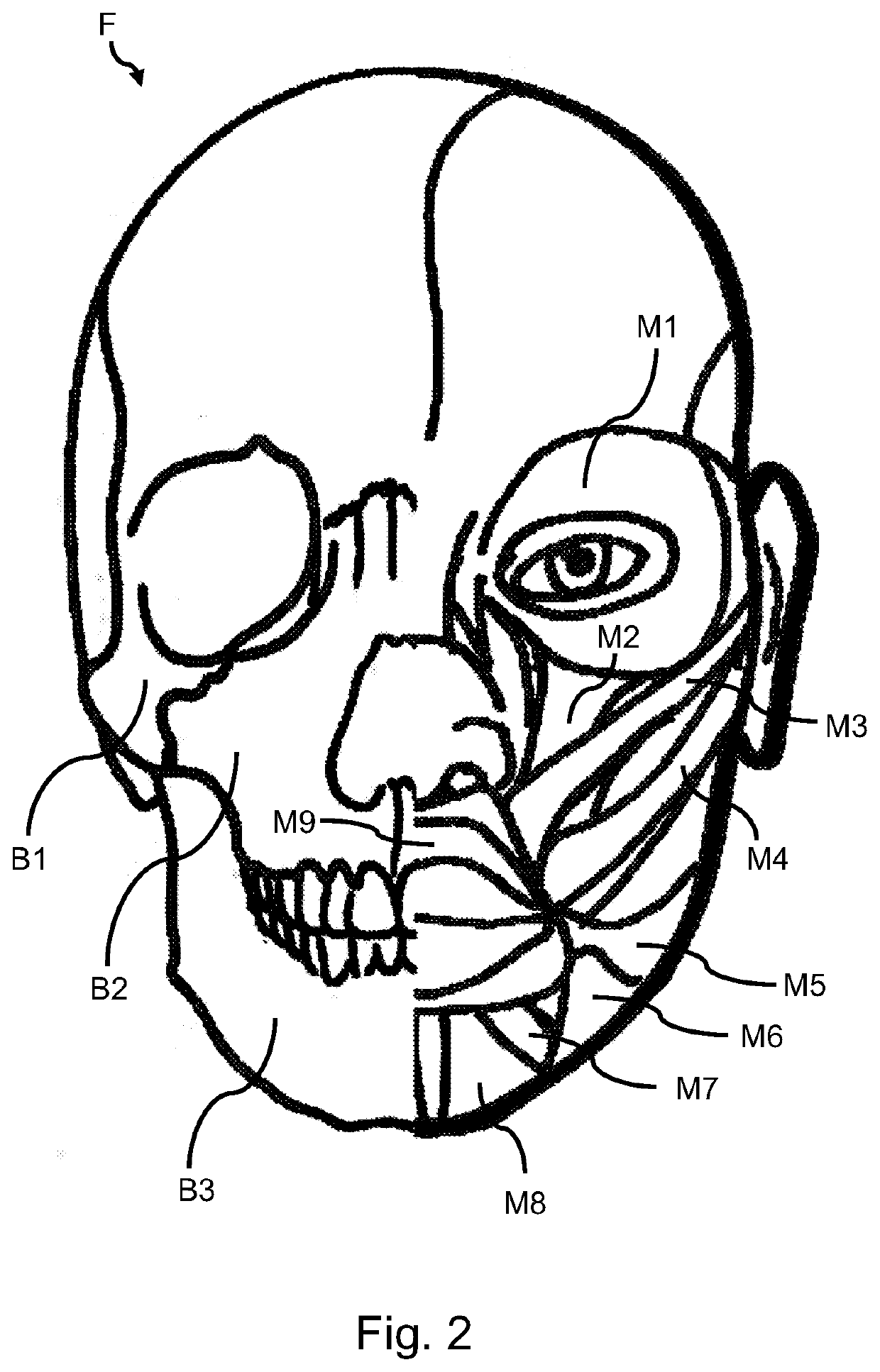 Apparatus for strengthening facial bones and muscle in cosmetic, stroke, and idiopathic facial paralysis patients and methods of use