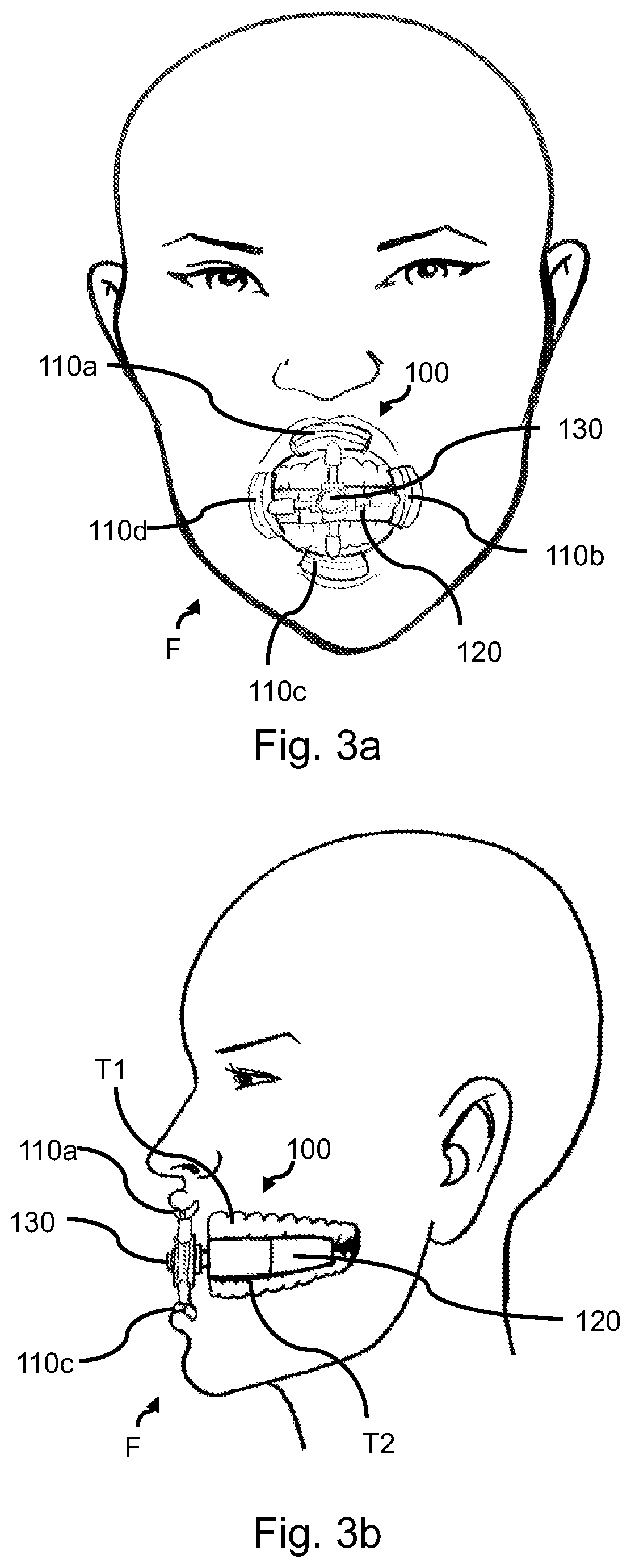 Apparatus for strengthening facial bones and muscle in cosmetic, stroke, and idiopathic facial paralysis patients and methods of use