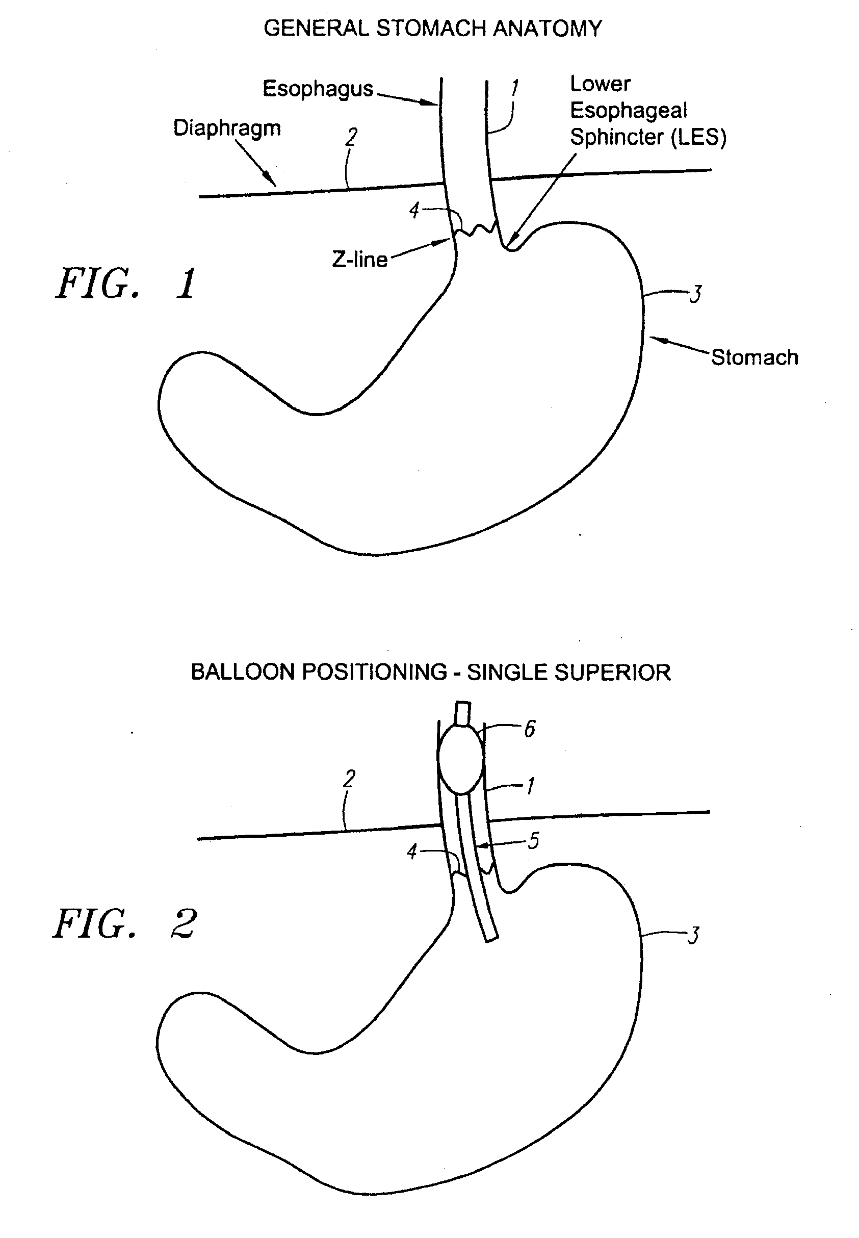 Methods and apparatus for treatment of obesity