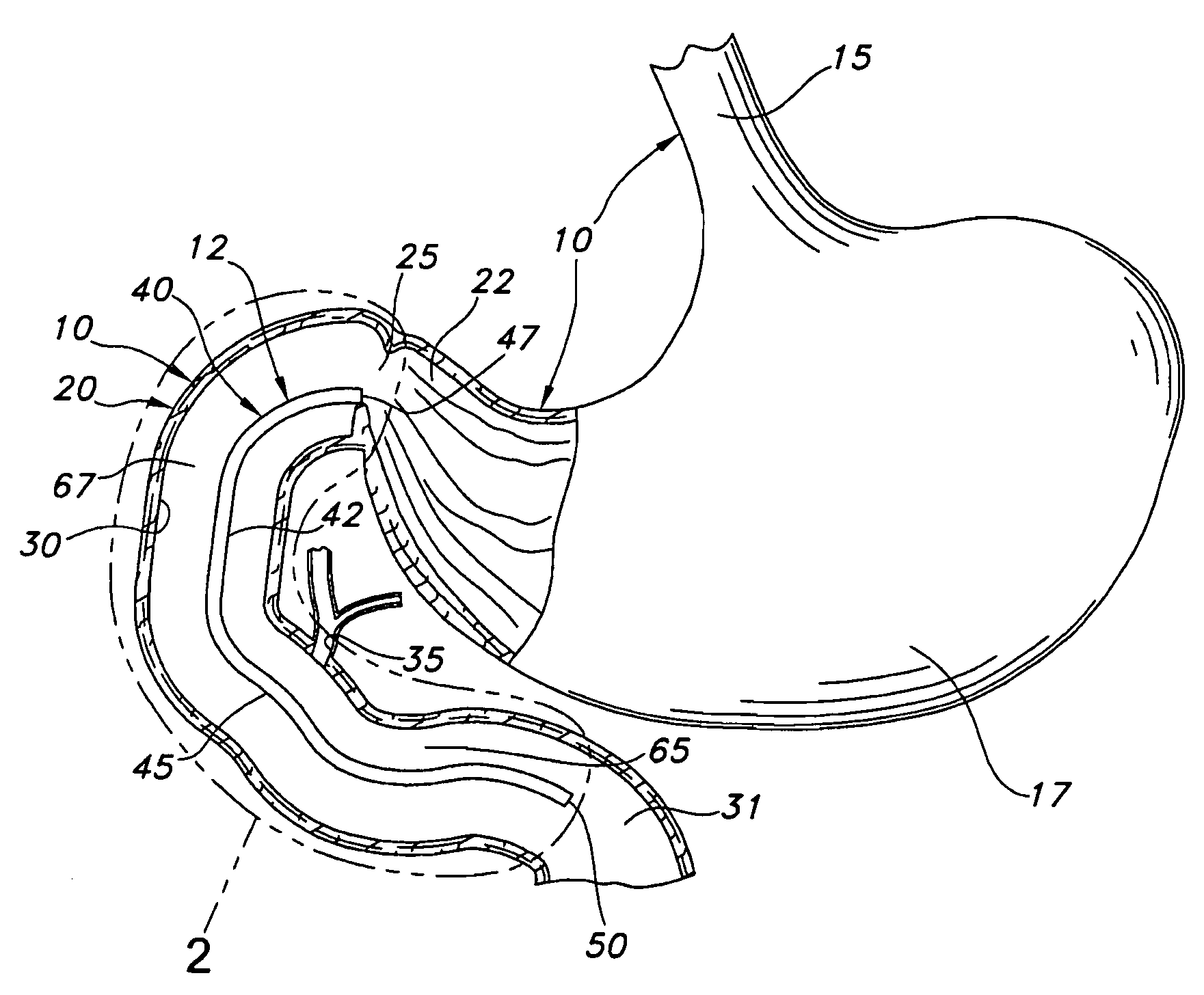 Anti-obesity diverter structure