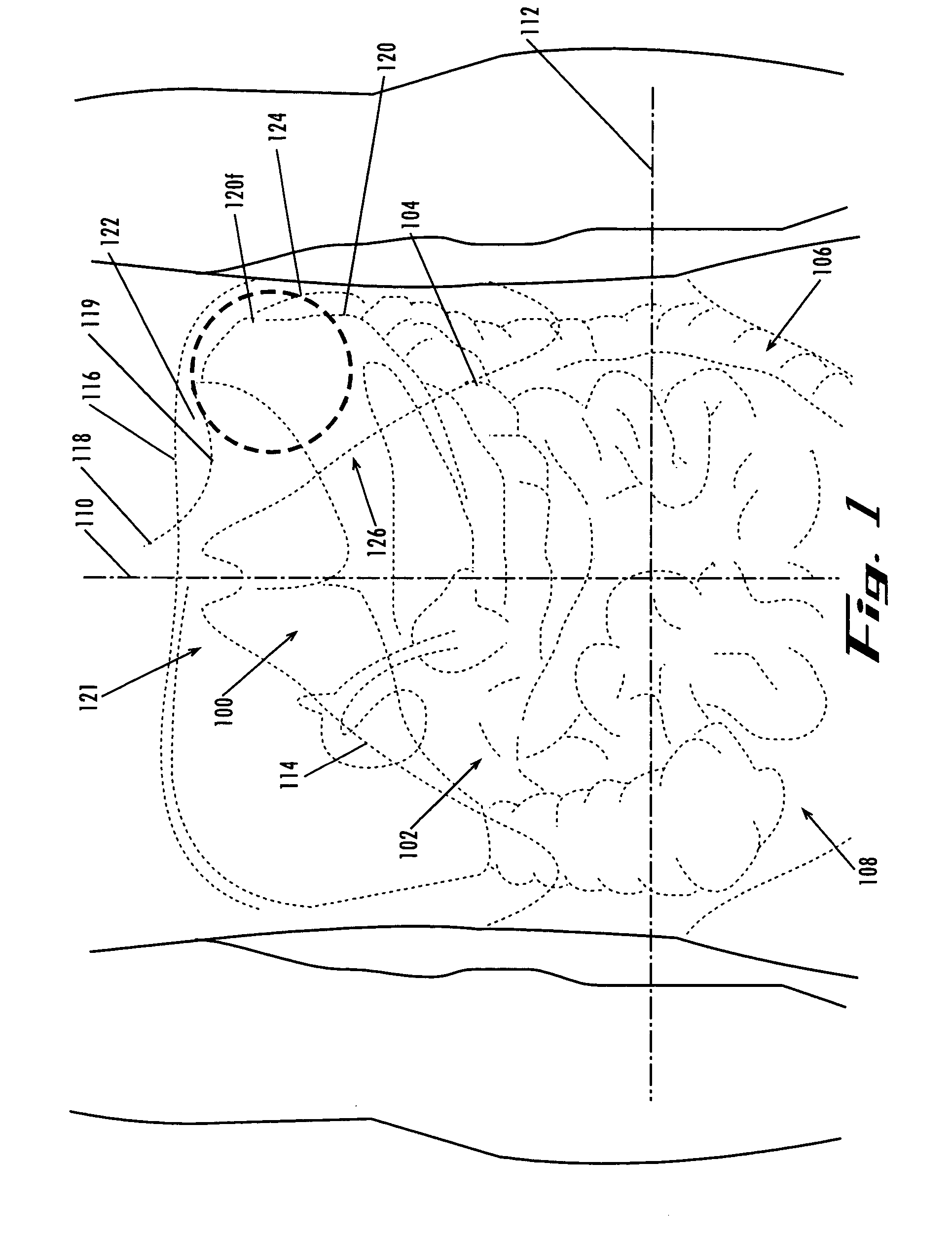 Devices and methods for treatment of obesity