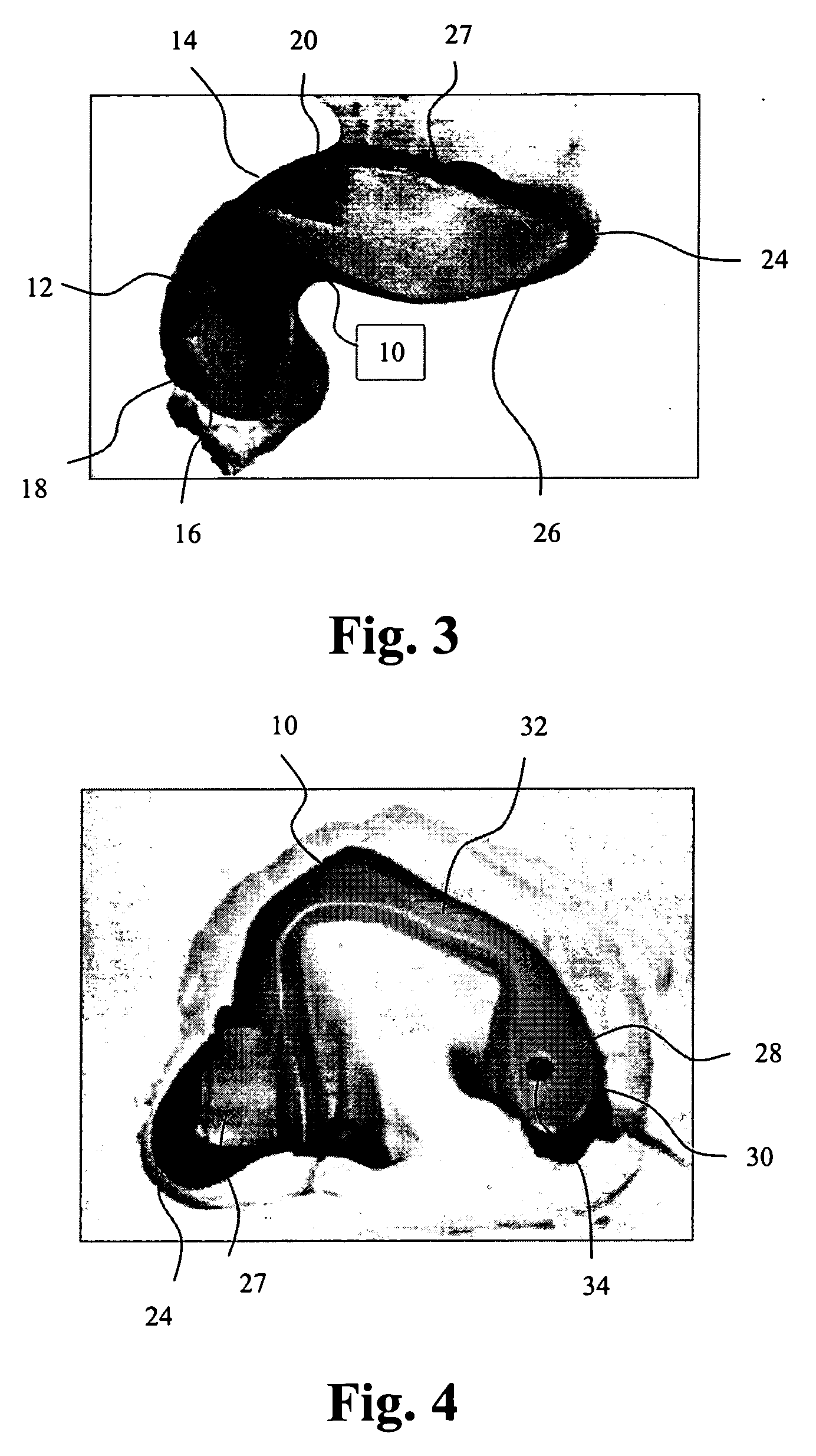 Open in-the-ear (ITE) hearing aid