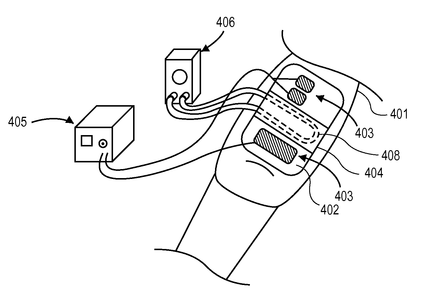 Devices and Systems for Stimulation of Tissues