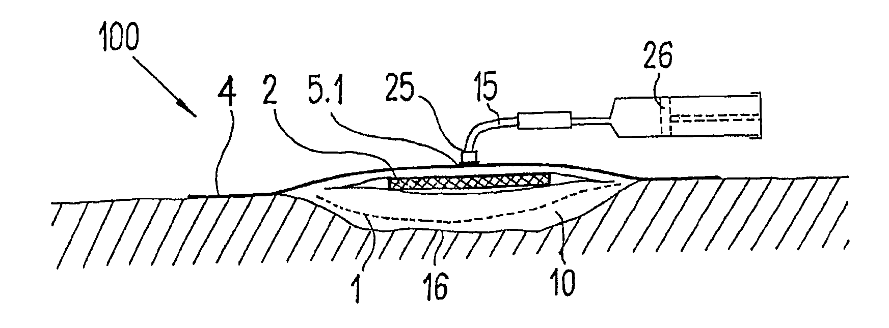 Device for the treatment of wounds using a vacuum
